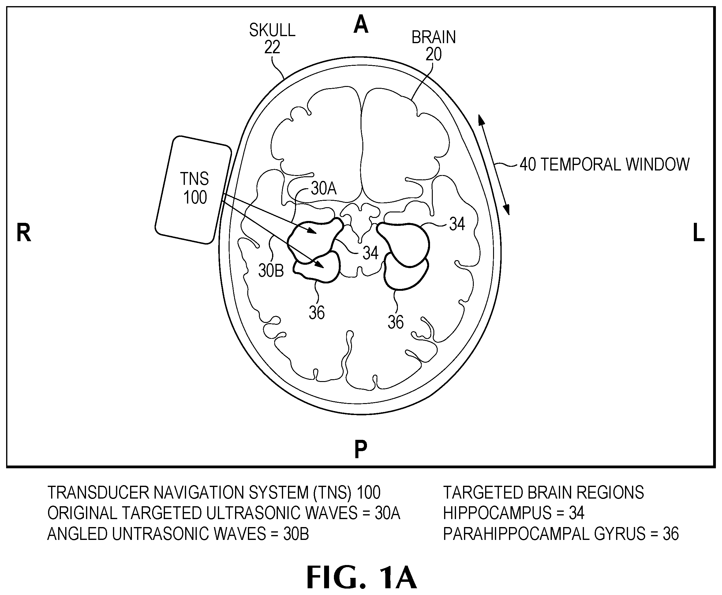 Patent US12350524 — Treating degenerative dementia with low intensity focused ultrasound pulsation (LIFUP) device — Figure 1