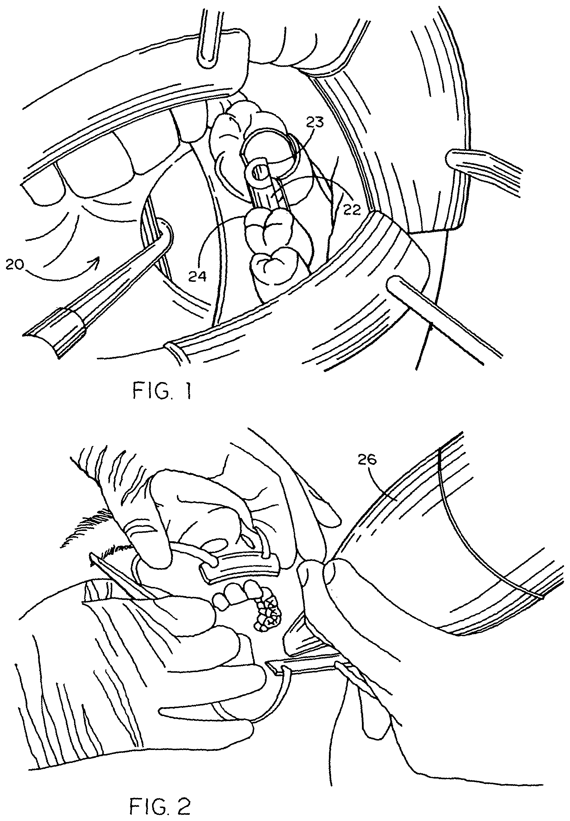 Patent US12367580 — Method of designing and fabricating patient-specific restorations from intra-oral scanning of a digital impression coping — Figure 1