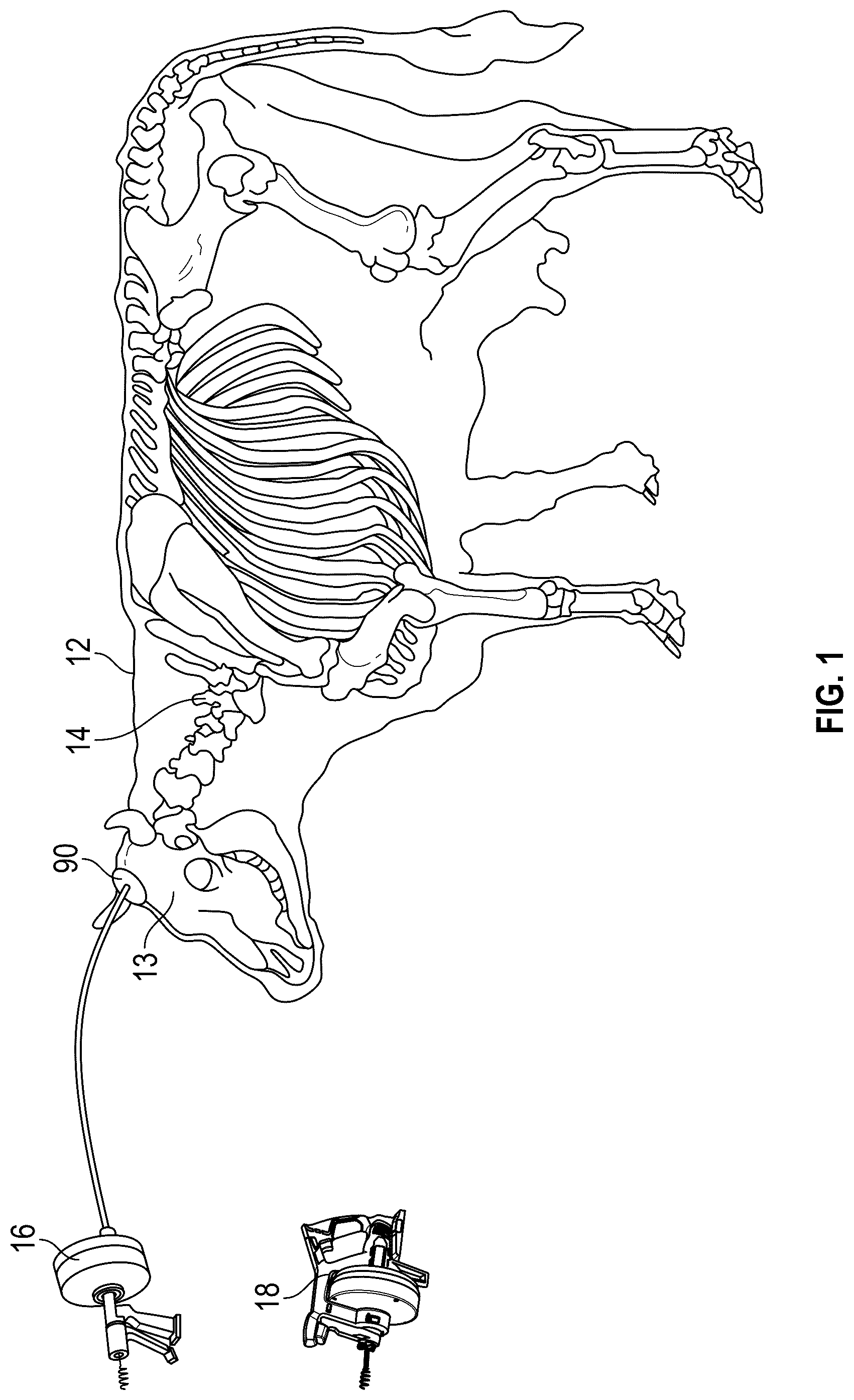 Patent US12376598 — Brain and spinal cord removal device and related methods — Figure 1