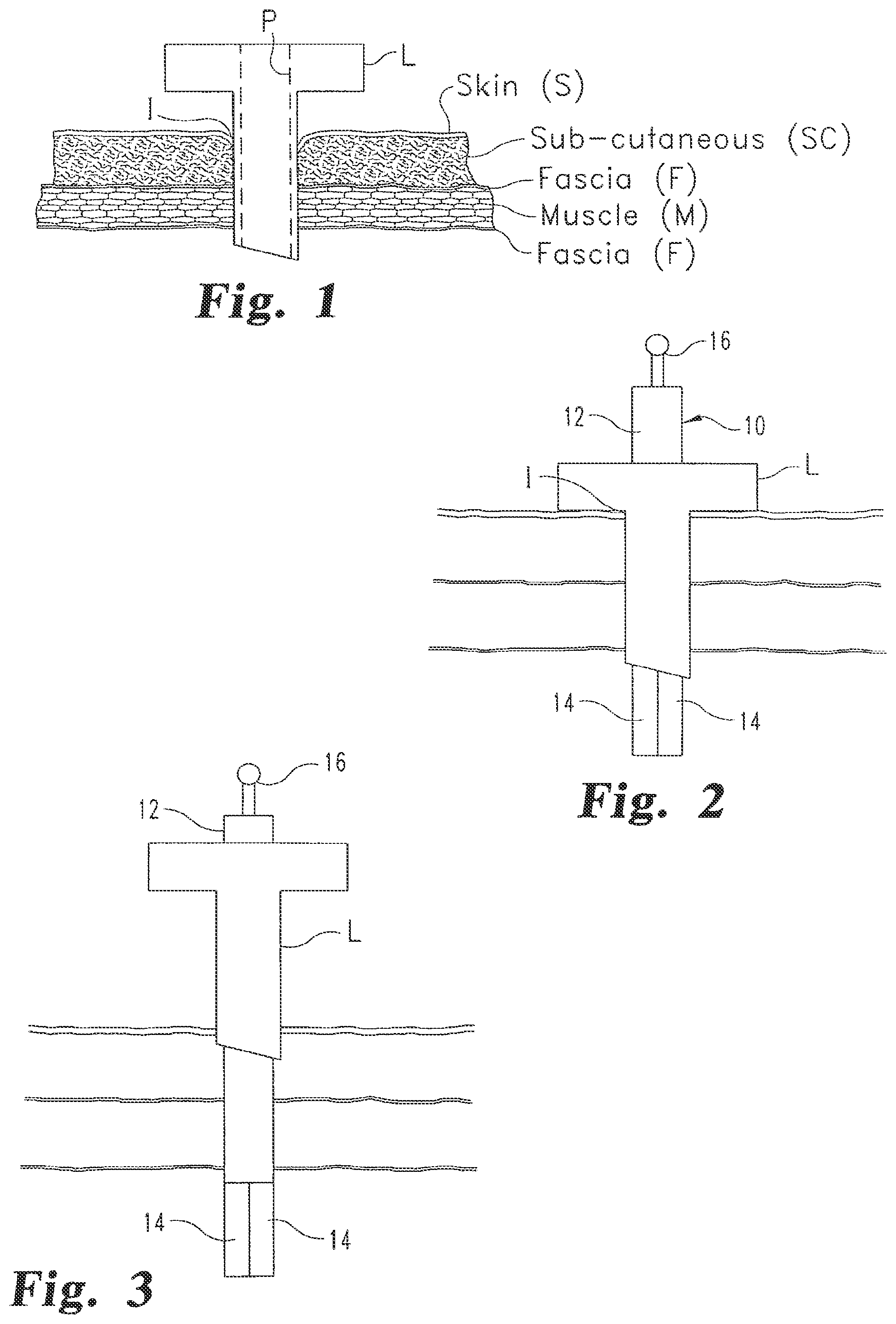 Patent US12376839 — Laparoscopic port site closure tool — Figure 1