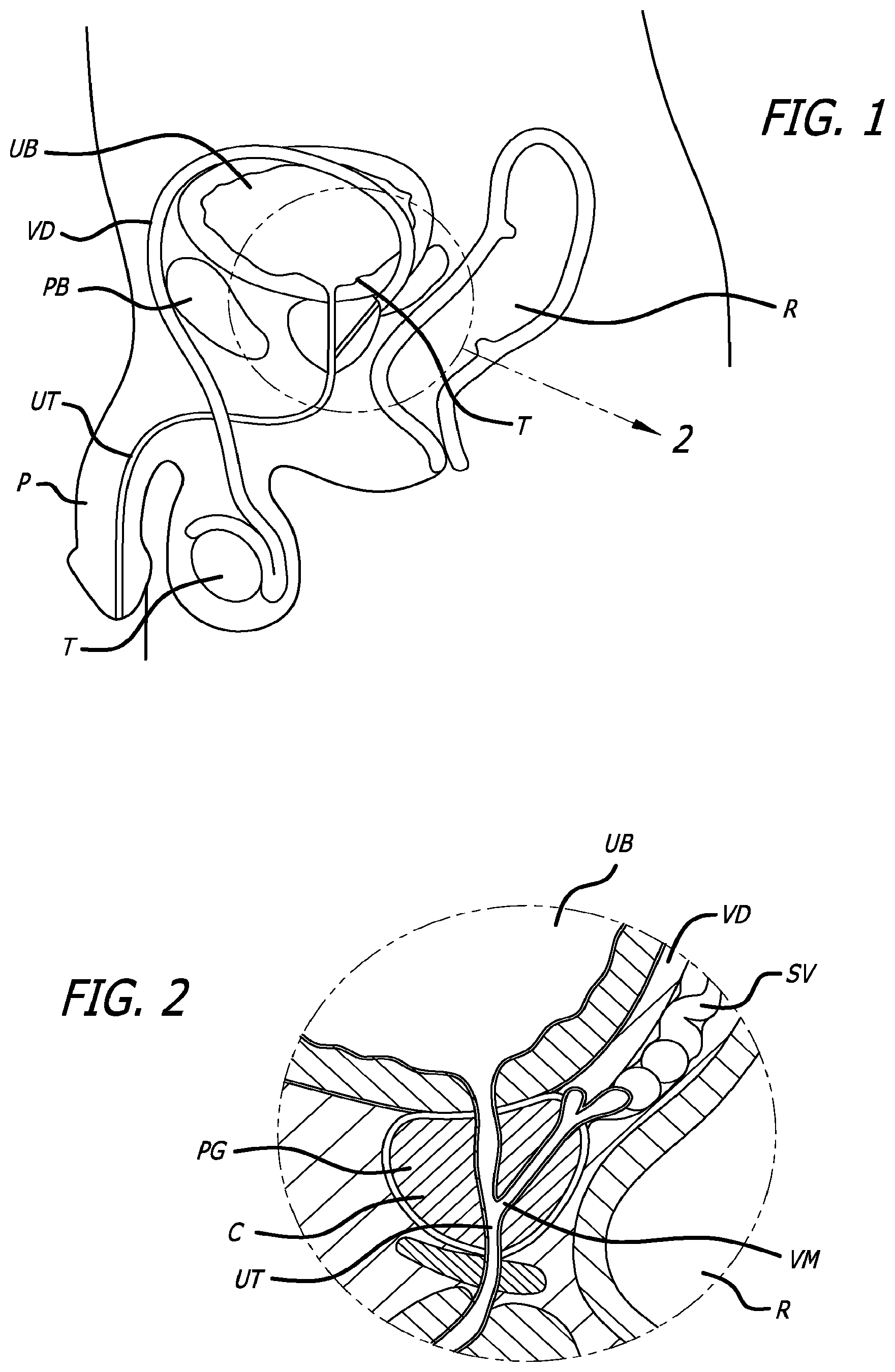 Patent US12376842 — Flexible system for delivering an anchor — Figure 1