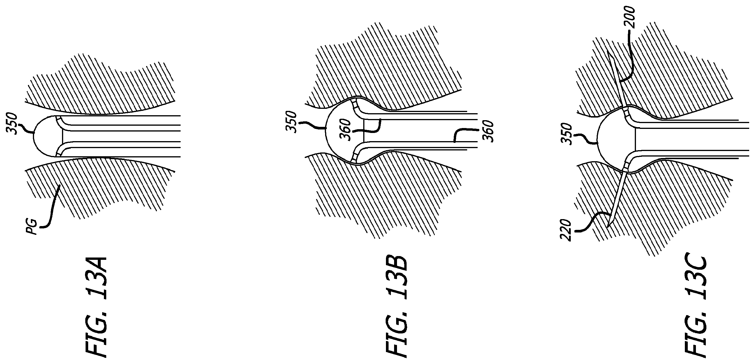 Patent US12376842 Figure 14 – Flexible system for delivering an anchor