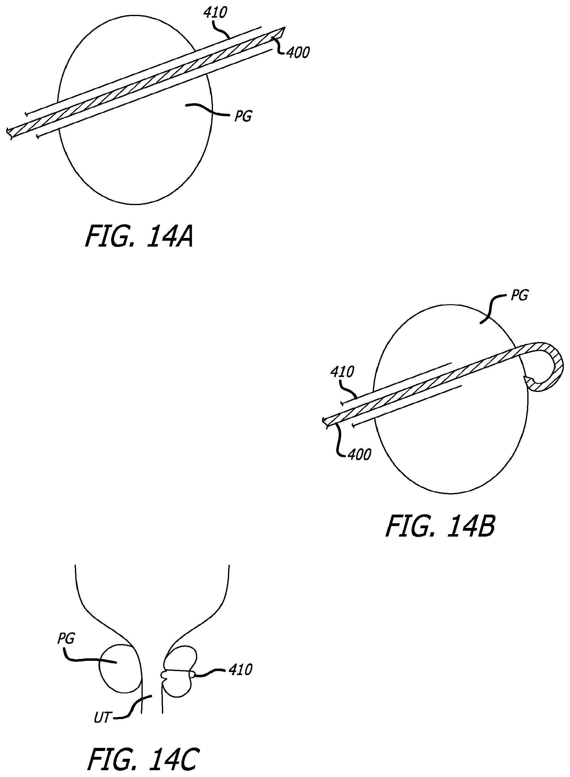Patent US12376842 Figure 15 – Flexible system for delivering an anchor