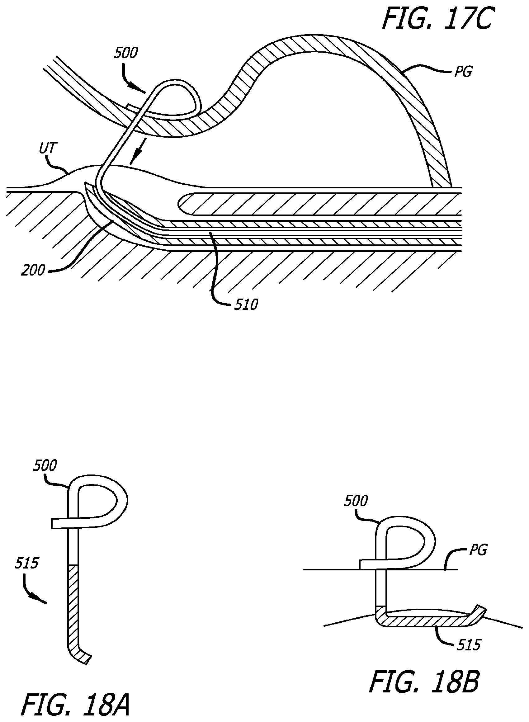 Patent US12376842 Figure 19 – Flexible system for delivering an anchor