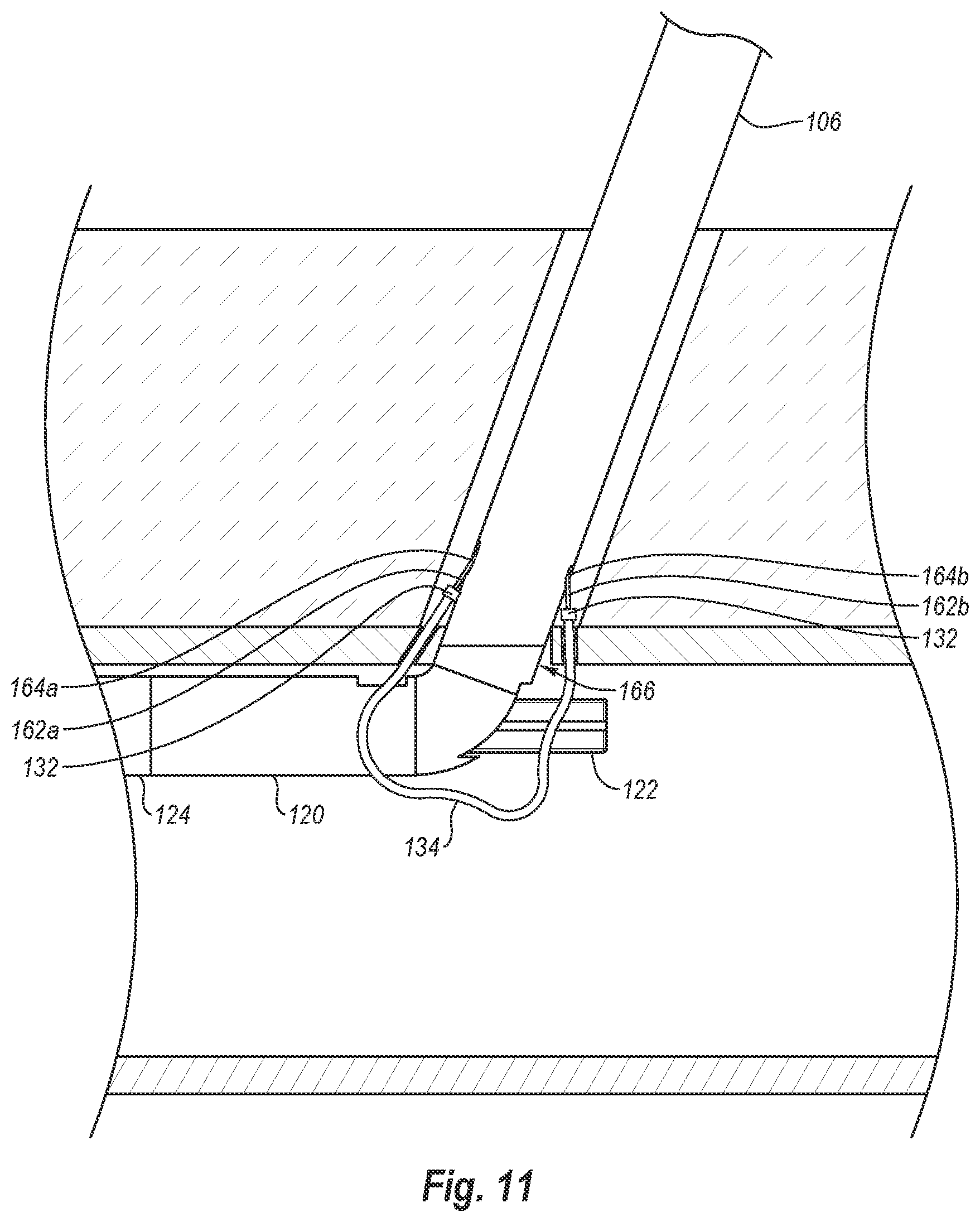 Patent US12376845 Figure 14 – Systems, methods, and devices for closing holes in body lumens