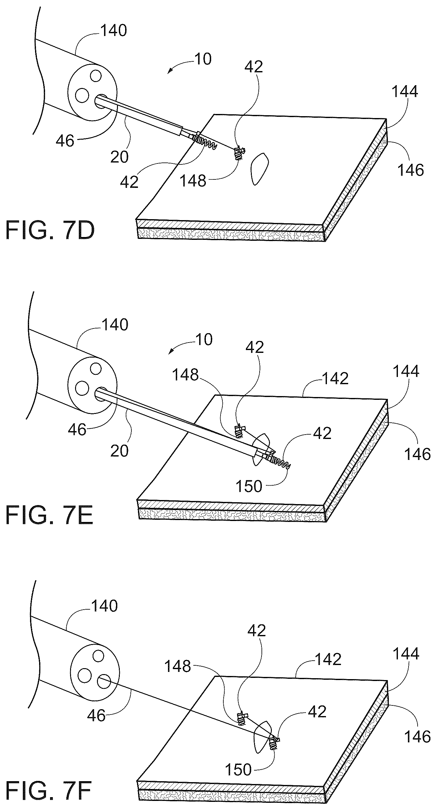 Patent US12376847 Figure 7 – Endoscopic tissue approximation system and methods