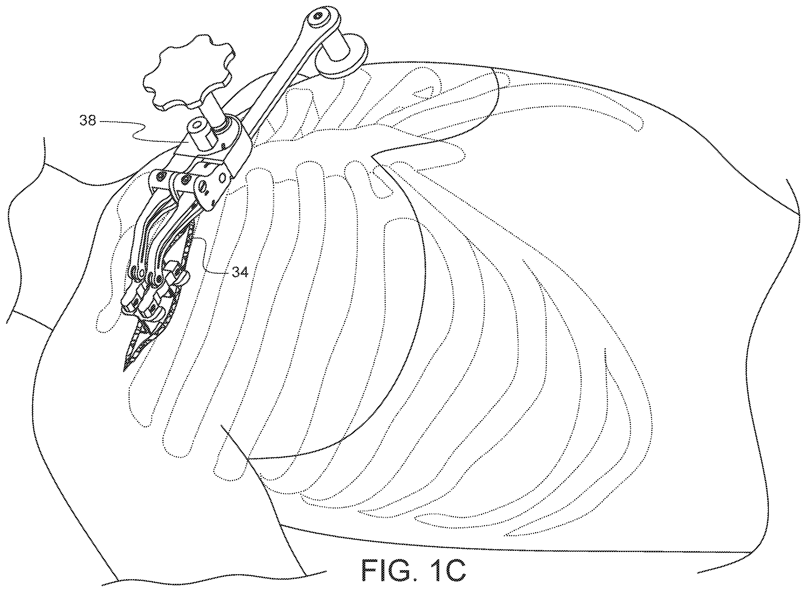 Patent US12376849 Figure 3 – Apparatus for suture management and methods thereof