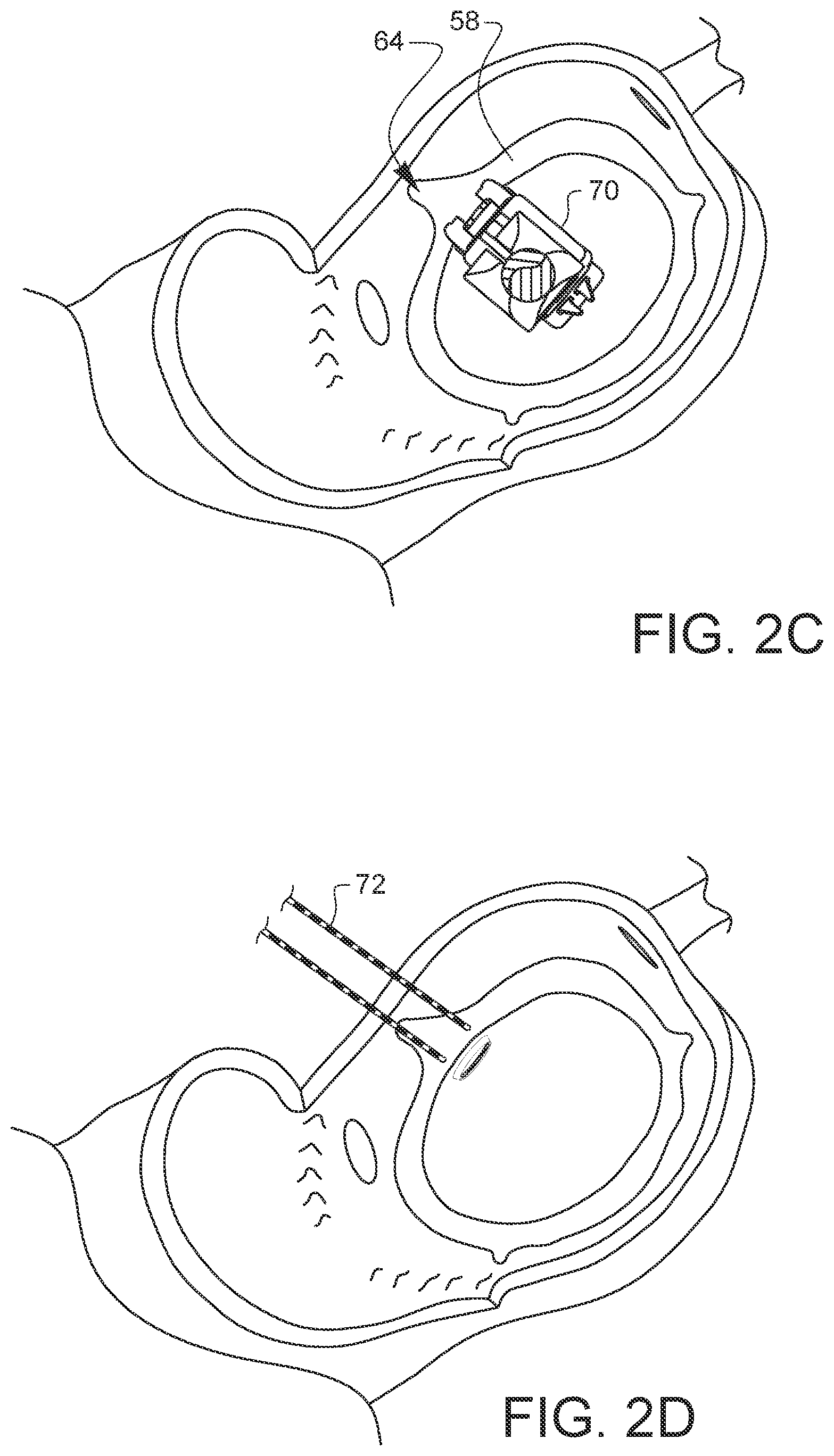 Patent US12376849 Figure 9 – Apparatus for suture management and methods thereof