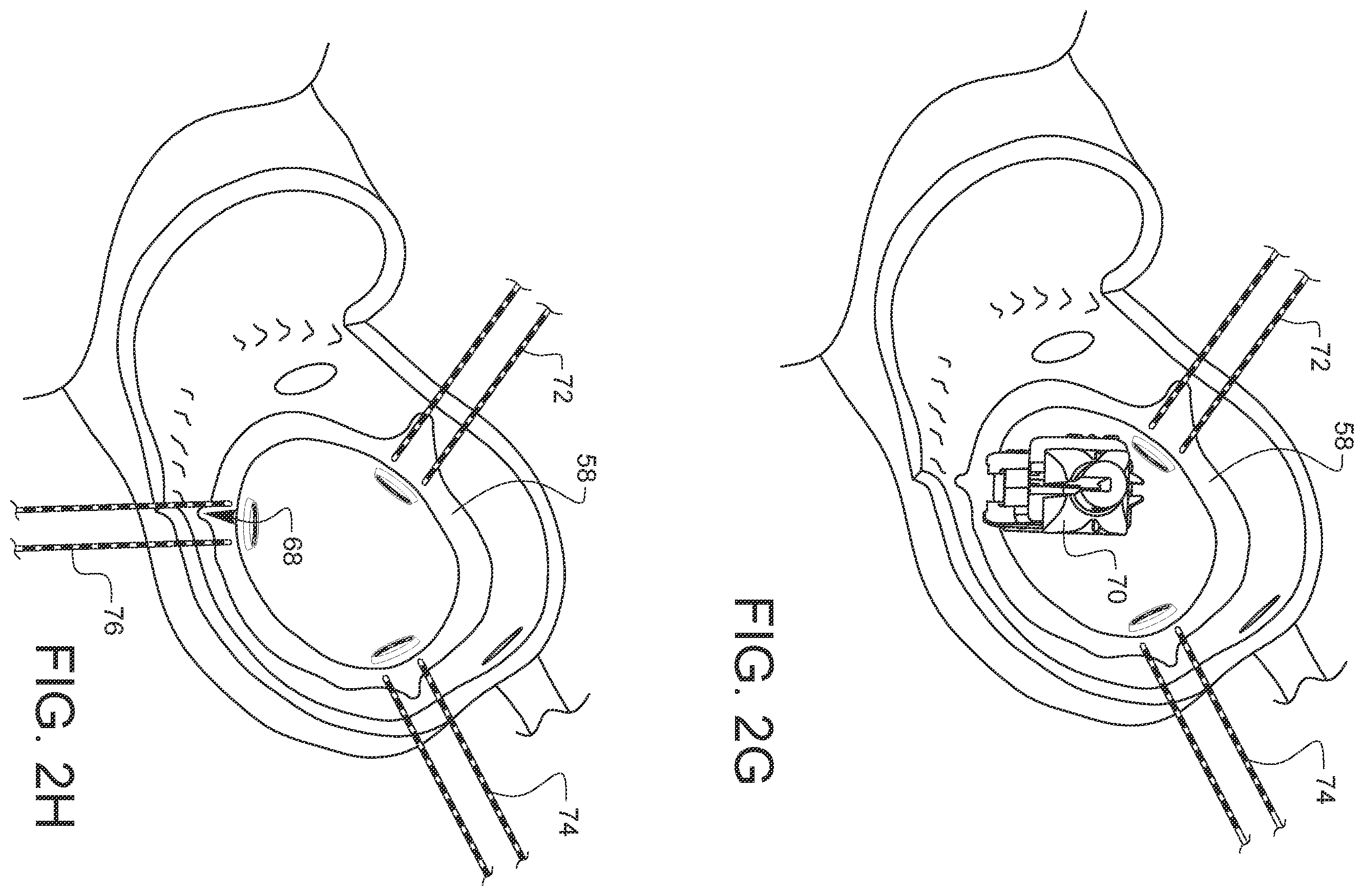Patent US12376849 Figure 11 – Apparatus for suture management and methods thereof