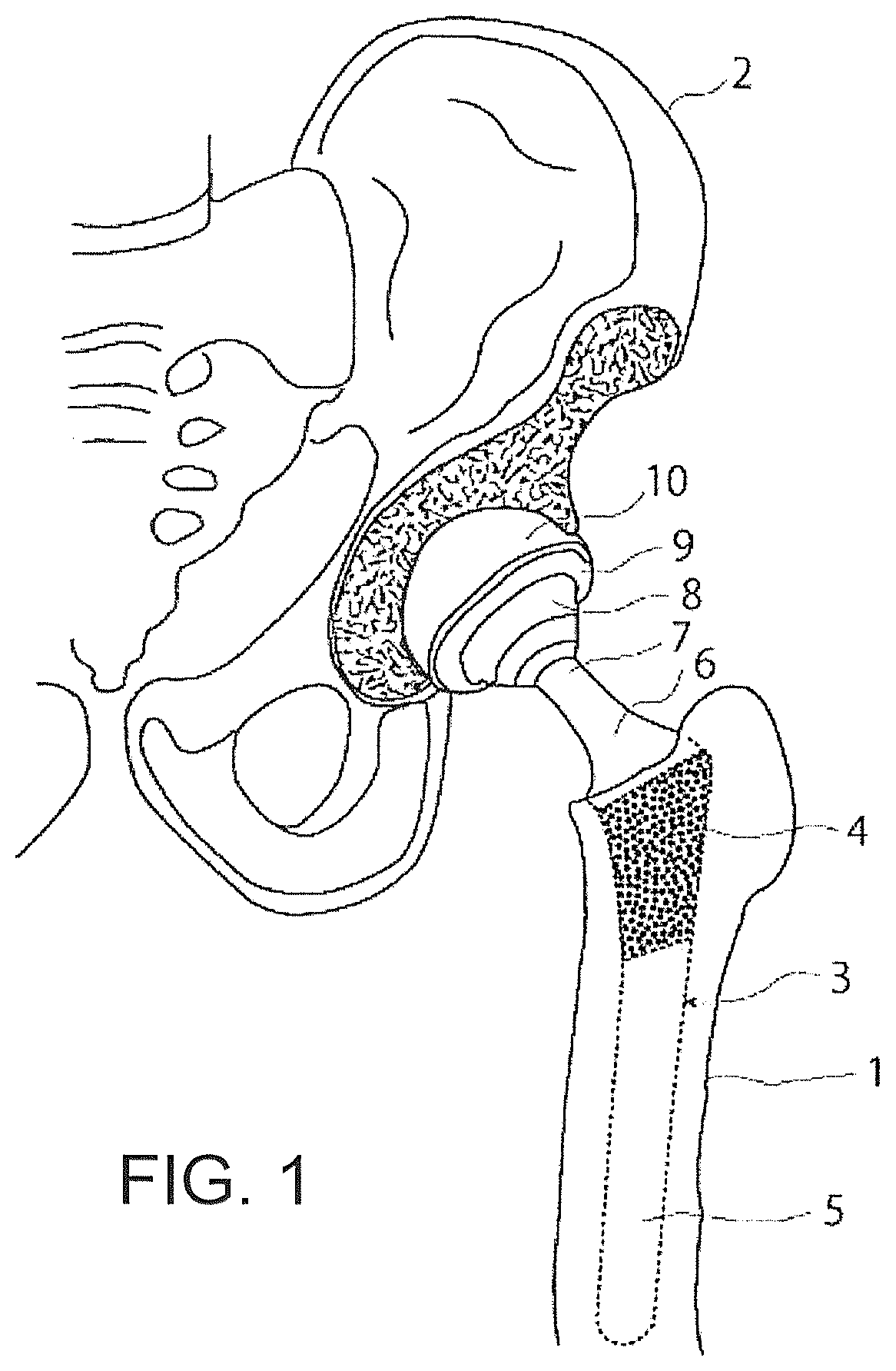 Patent US12376866 — Thin-blade chisel system — Figure 1