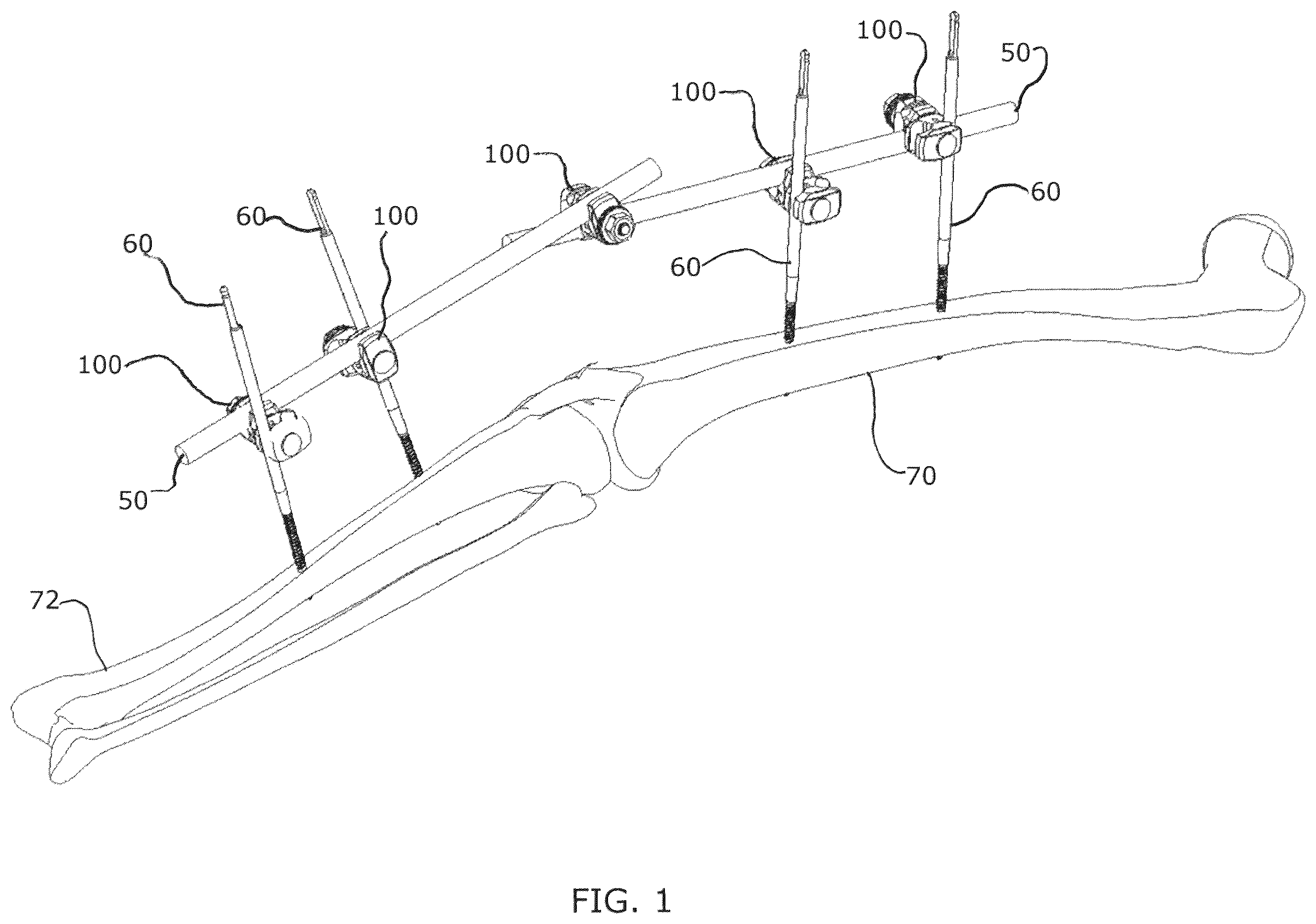 Patent US12376885 — External fixator assembly — Figure 1
