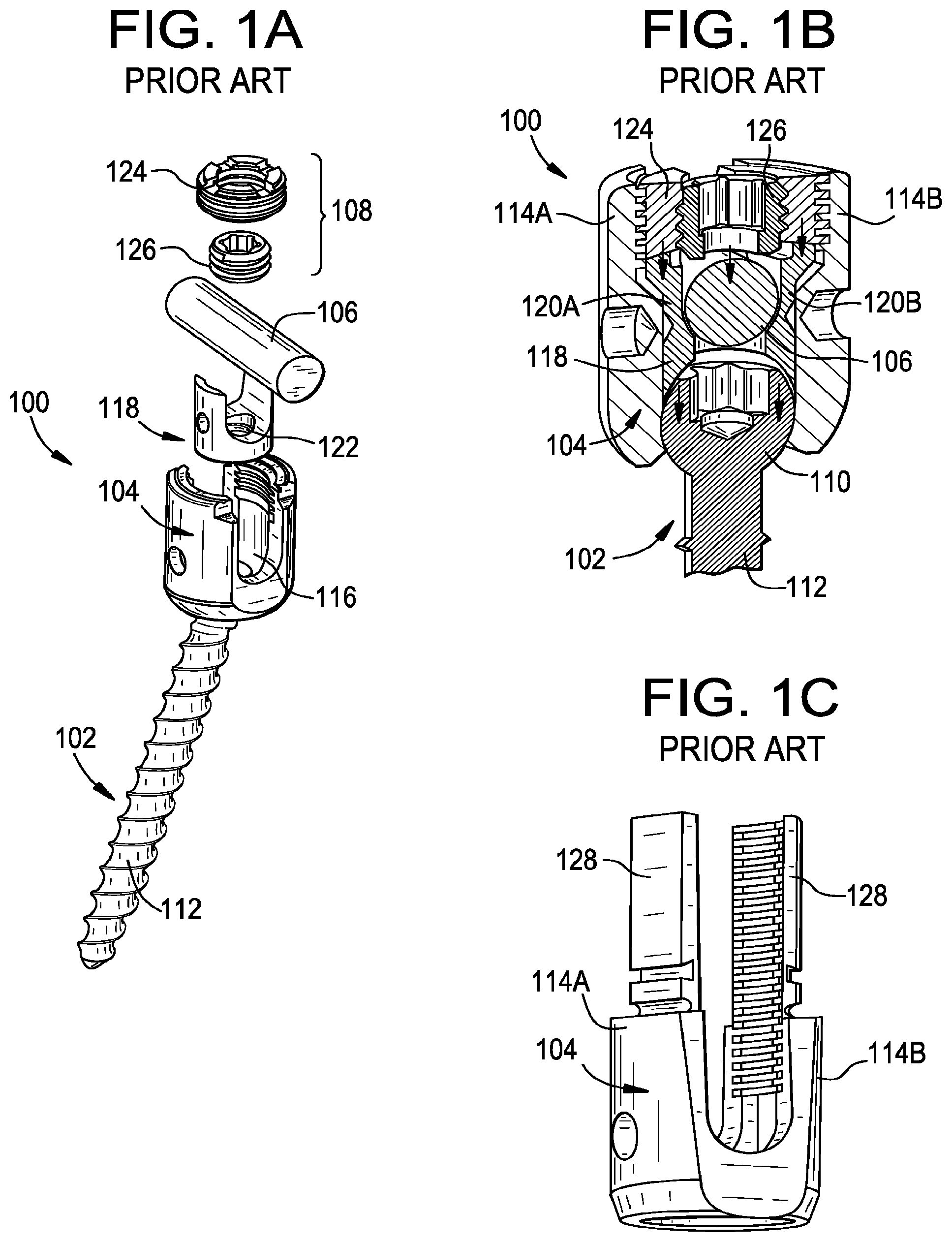 Patent US12376888 — Multipoint fixation implants — Figure 1