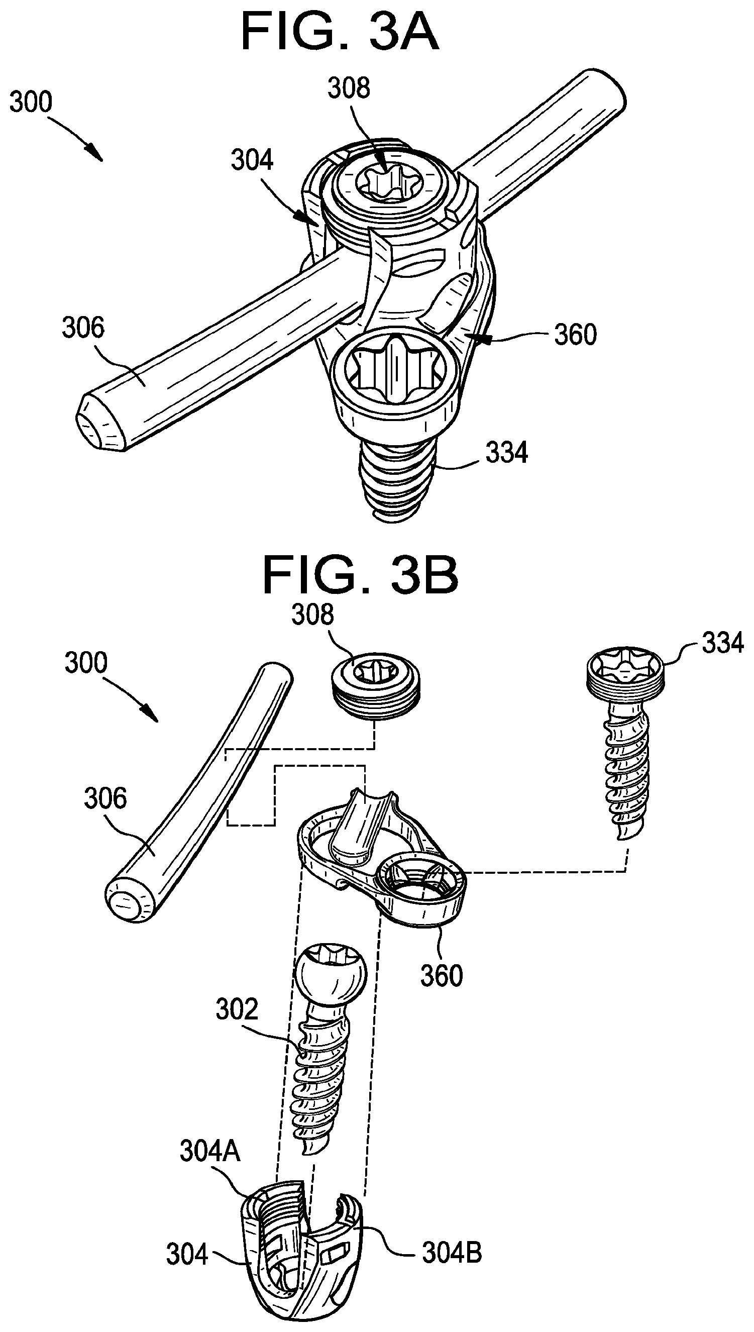 Patent US12376888 Figure 7 – Multipoint fixation implants