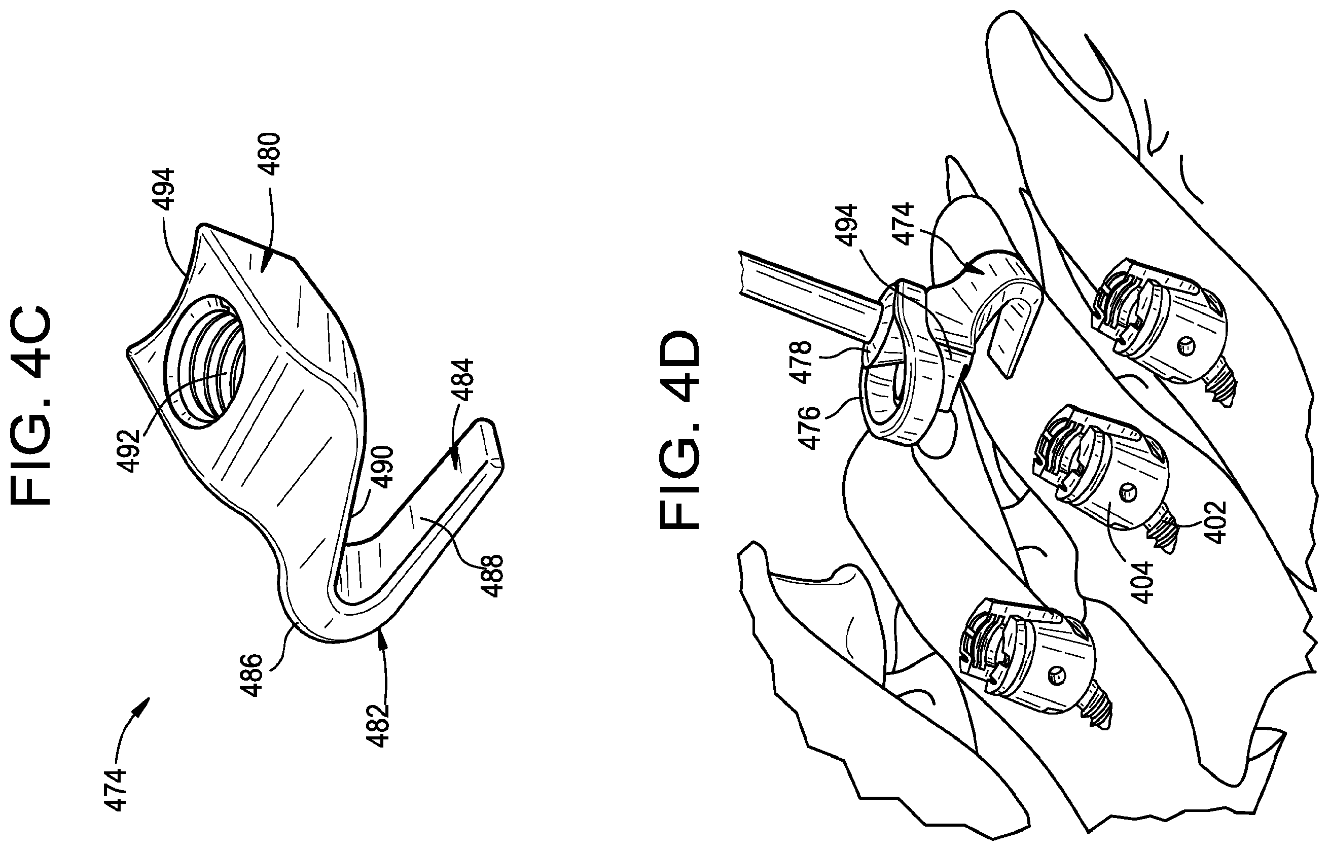 Patent US12376888 Figure 12 – Multipoint fixation implants