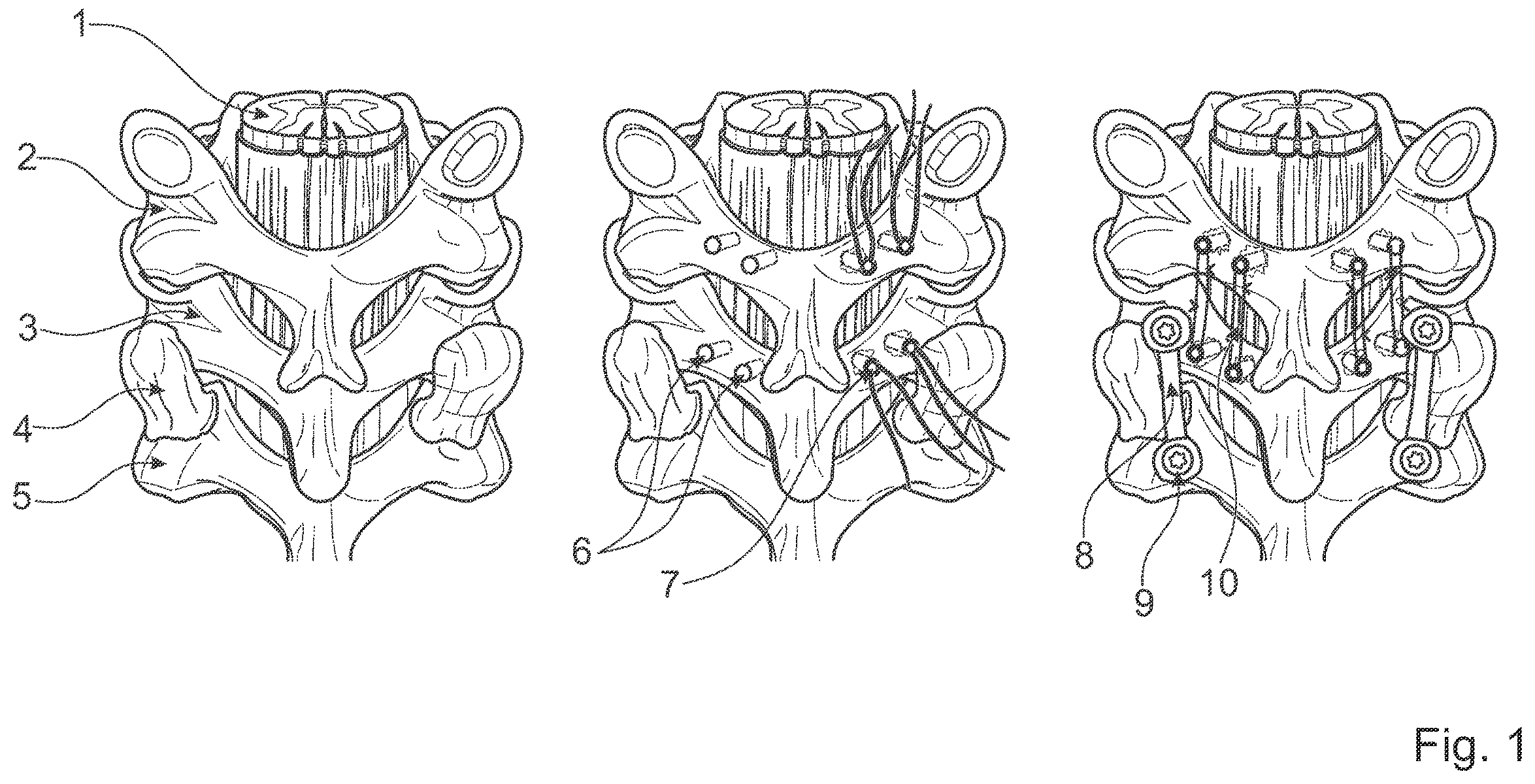 Patent US12376891 — Surgical methods for the treatment of spinal stenosis — Figure 1