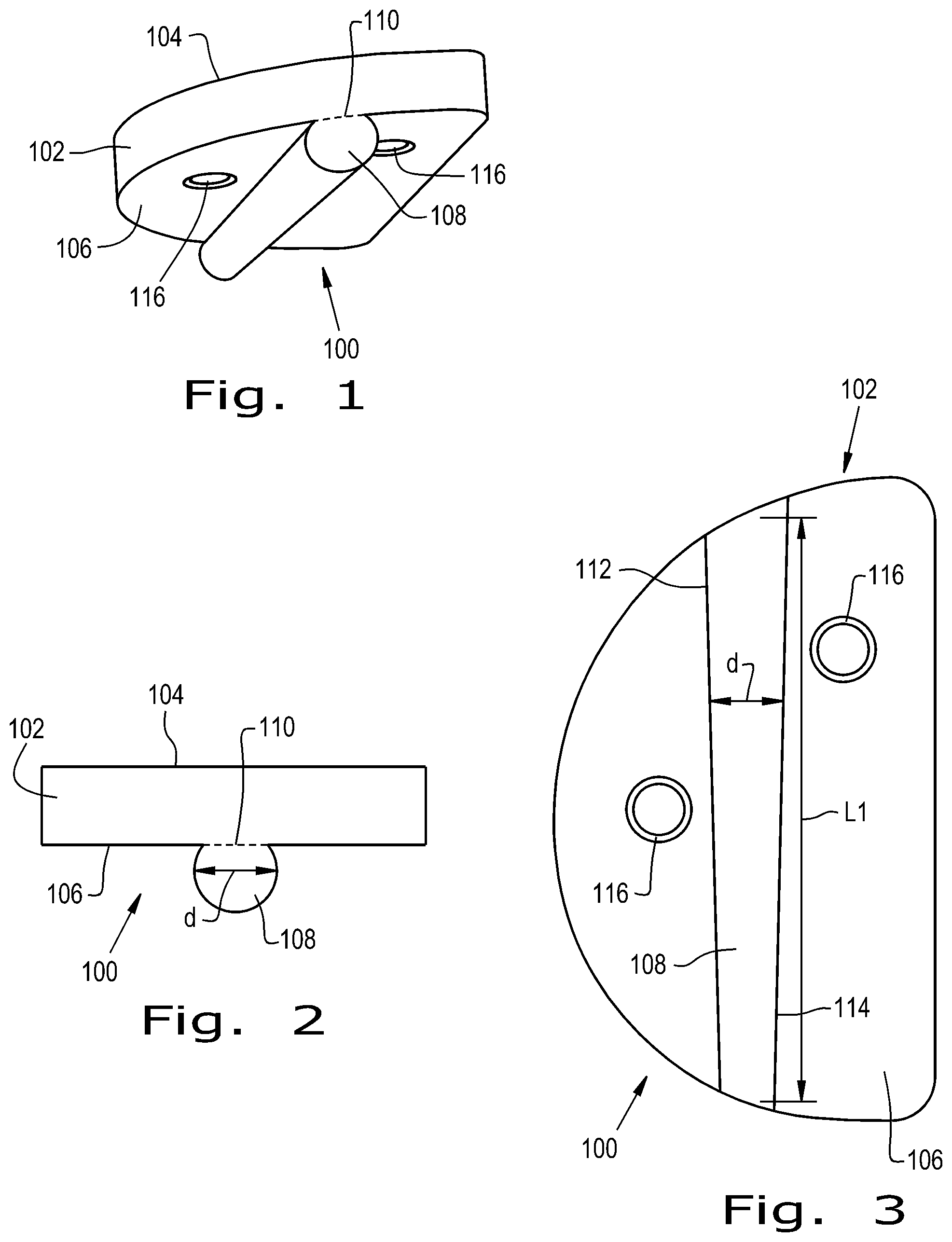 Patent US12376893 — Orthopaedic implant with fixation feature and a method of implanting thereof — Figure 1