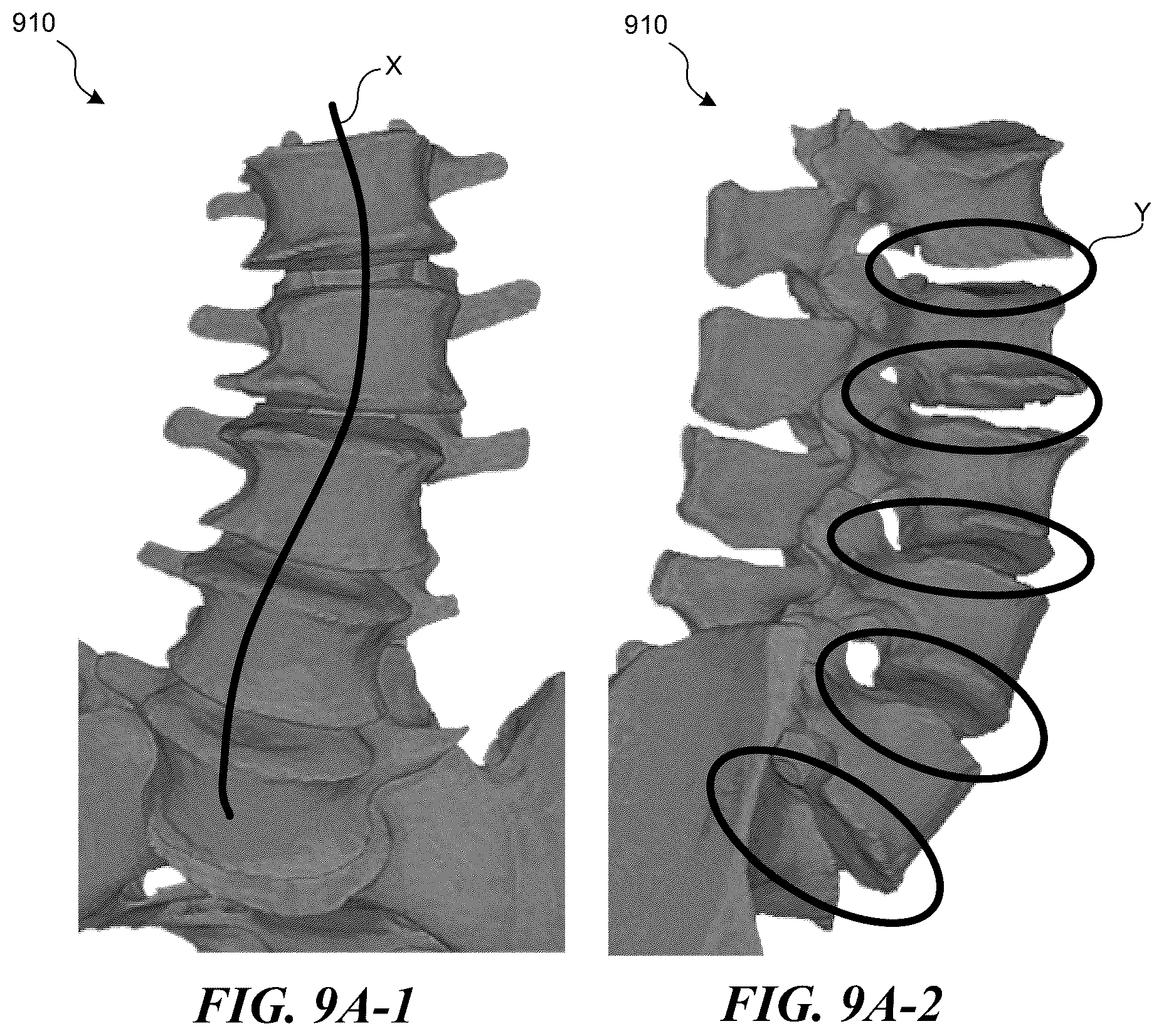 Patent US12376907 Figure 13 – Patient-specific medical systems, devices, and methods