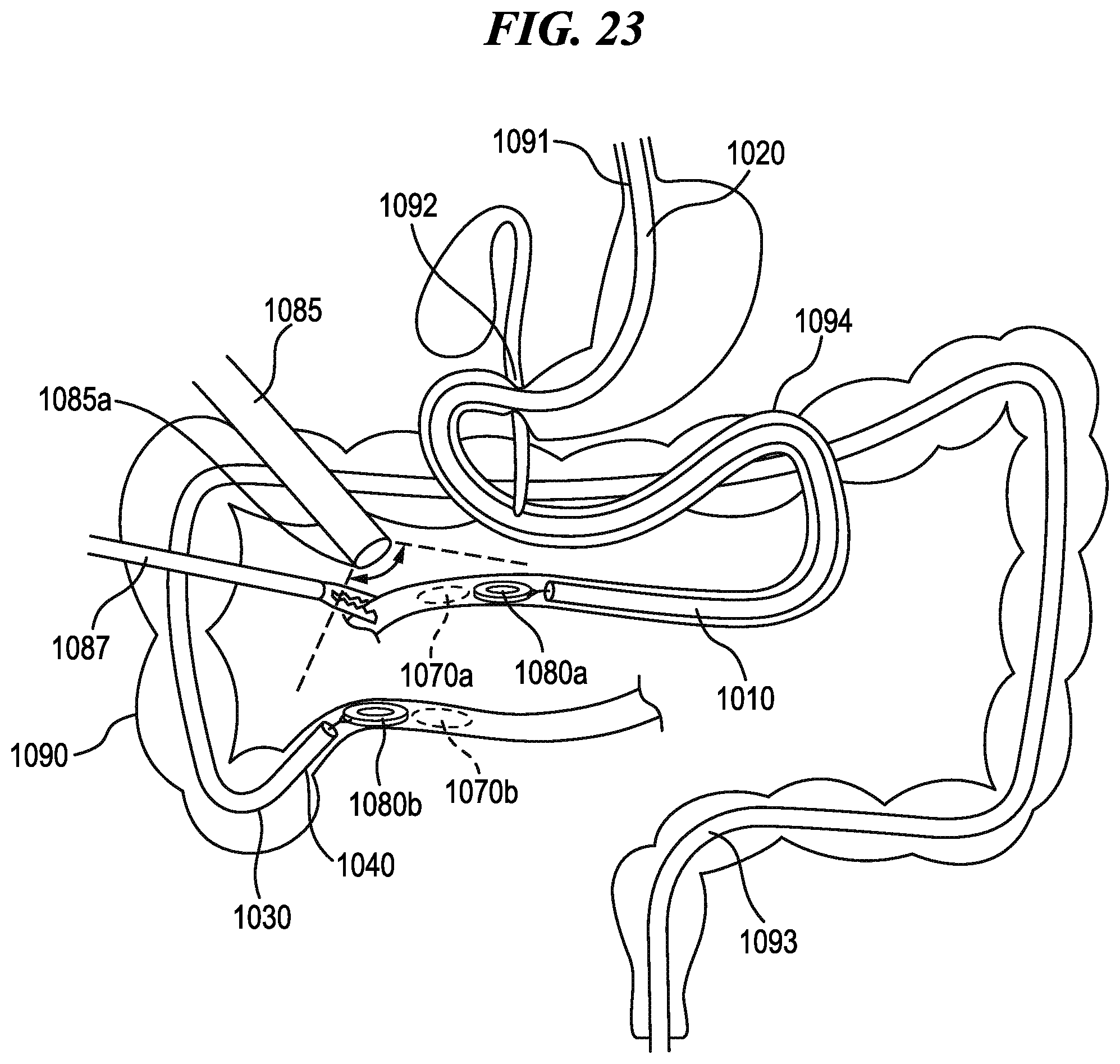 Patent US12376910 Figure 17 – Methods for controlling cooperative surgical instruments