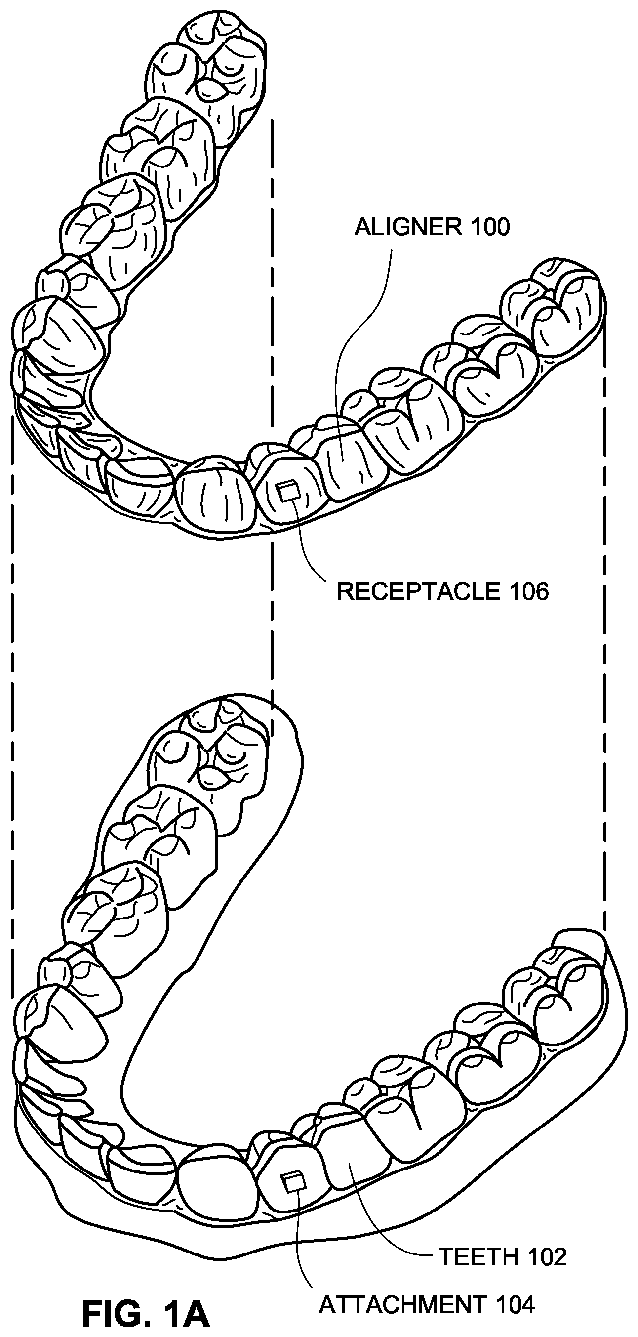 Patent US12376945 — Orthodontic appliances with discontinuities and elastics — Figure 1