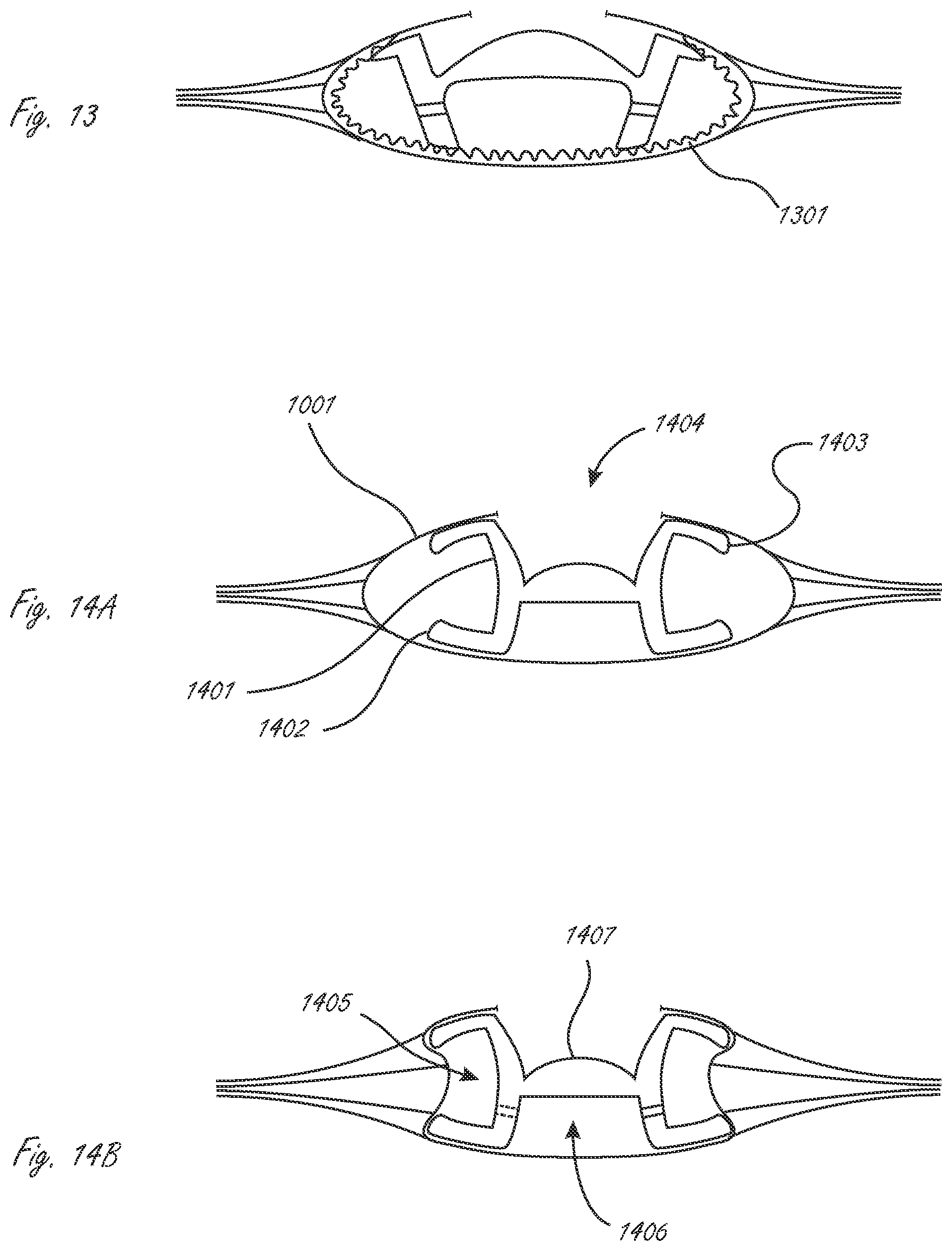 Patent US12376958 Figure 4 – Multi-piece accommodating intraocular lens