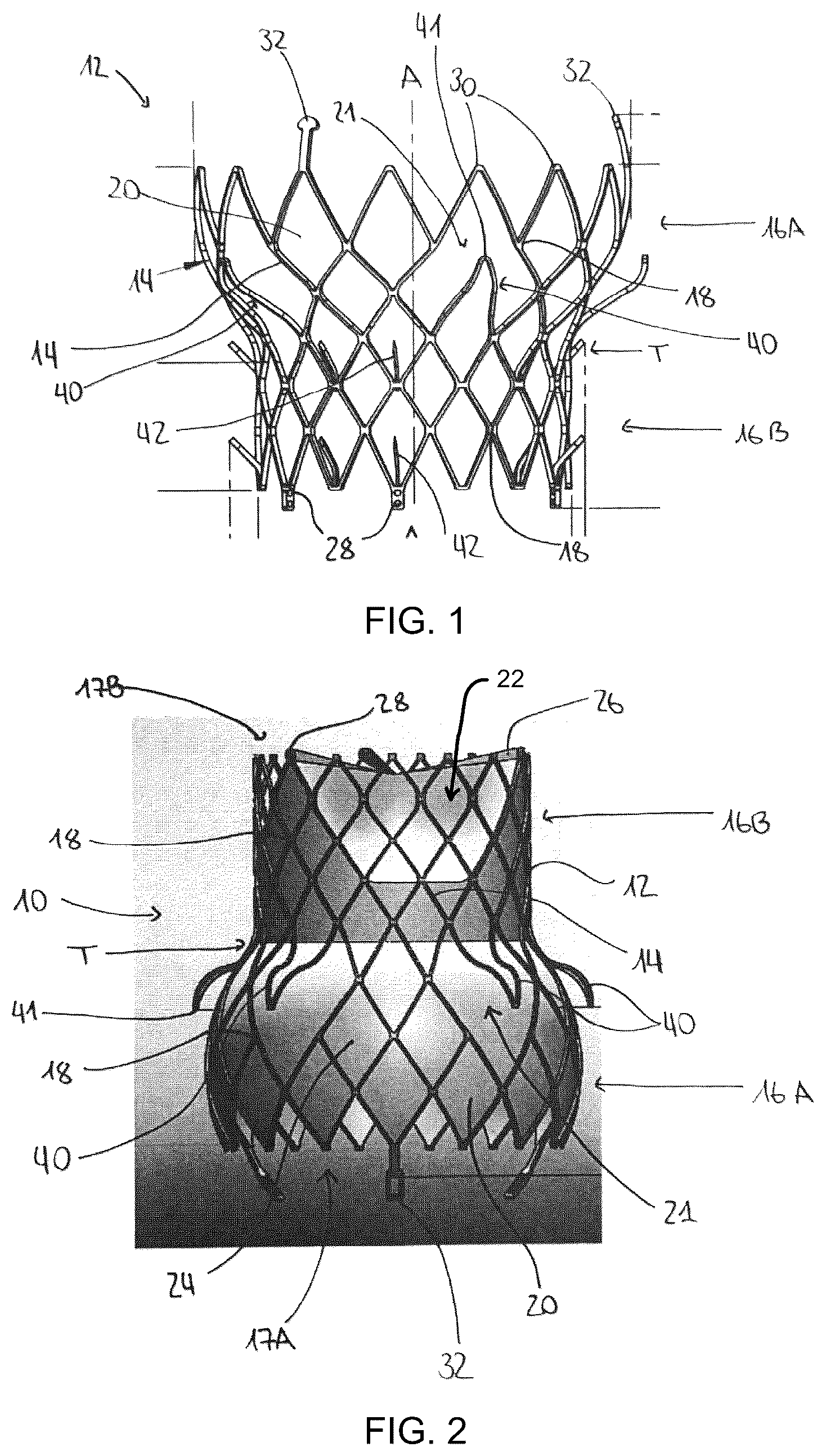 Patent US12376960 Figure 1 – Mitral stent