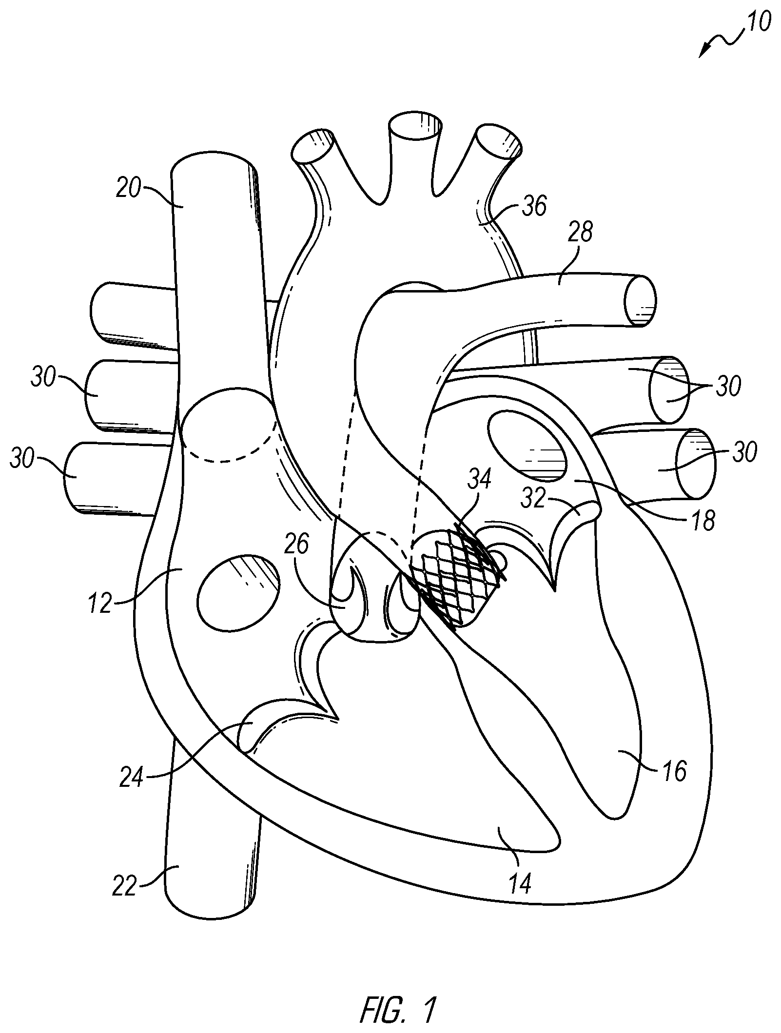 Patent US12376962 — Methods and devices for delivery of a prosthetic valve — Figure 1