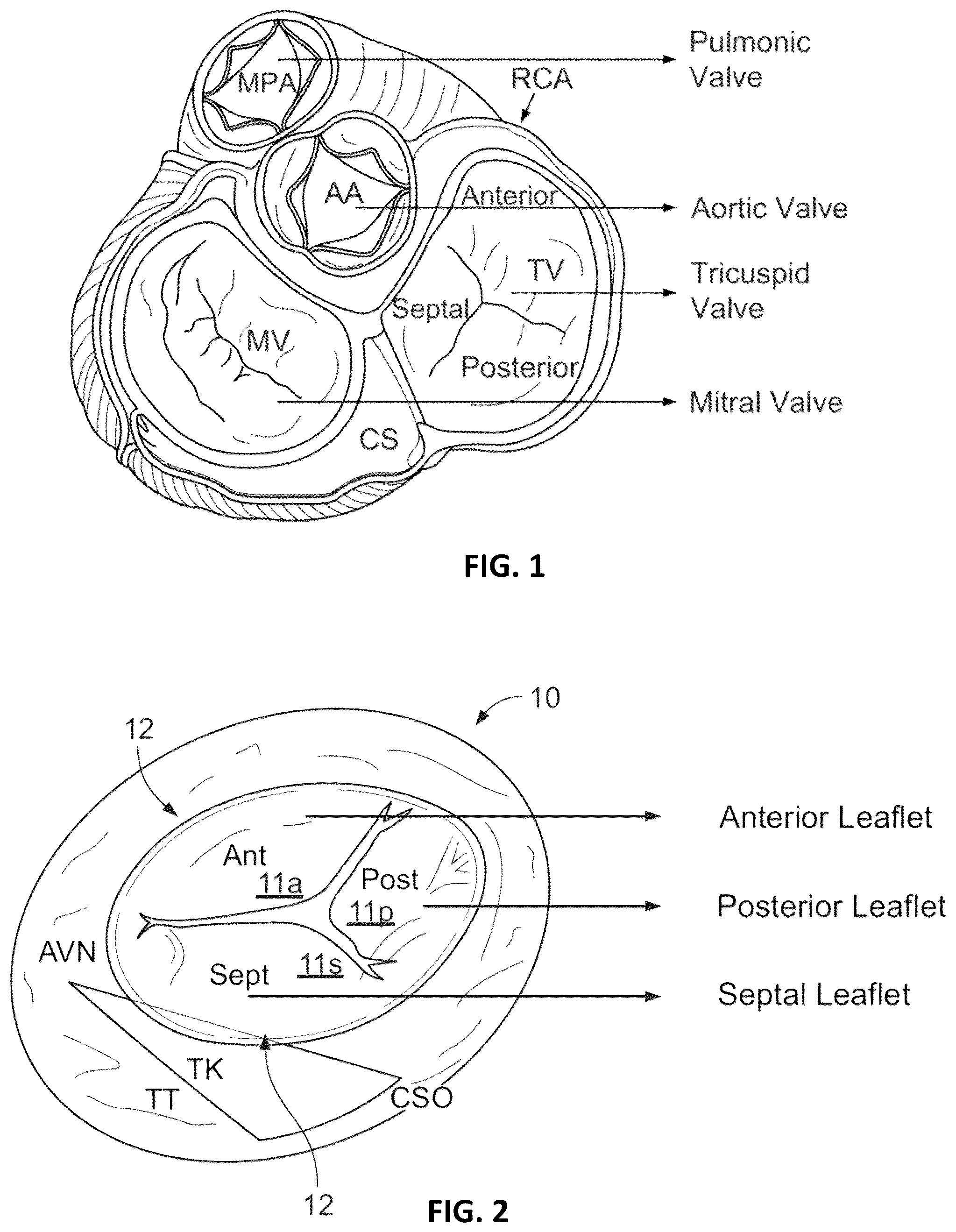 Patent US12376963 Figure 1 – Prosthetic heart valves