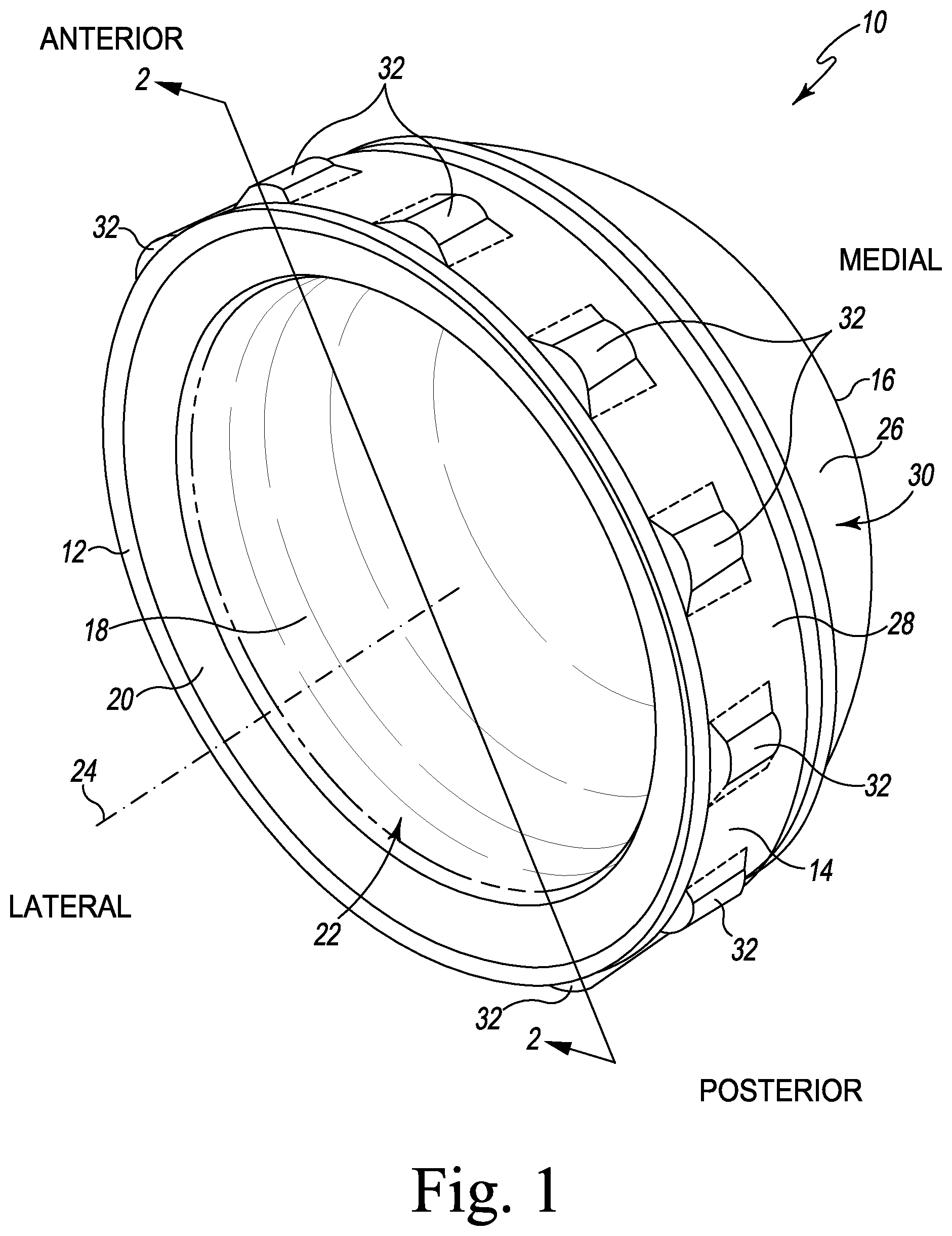 Patent US12376964 — Apparatus and method for locking an acetabular liner to an acetabular cup — Figure 1