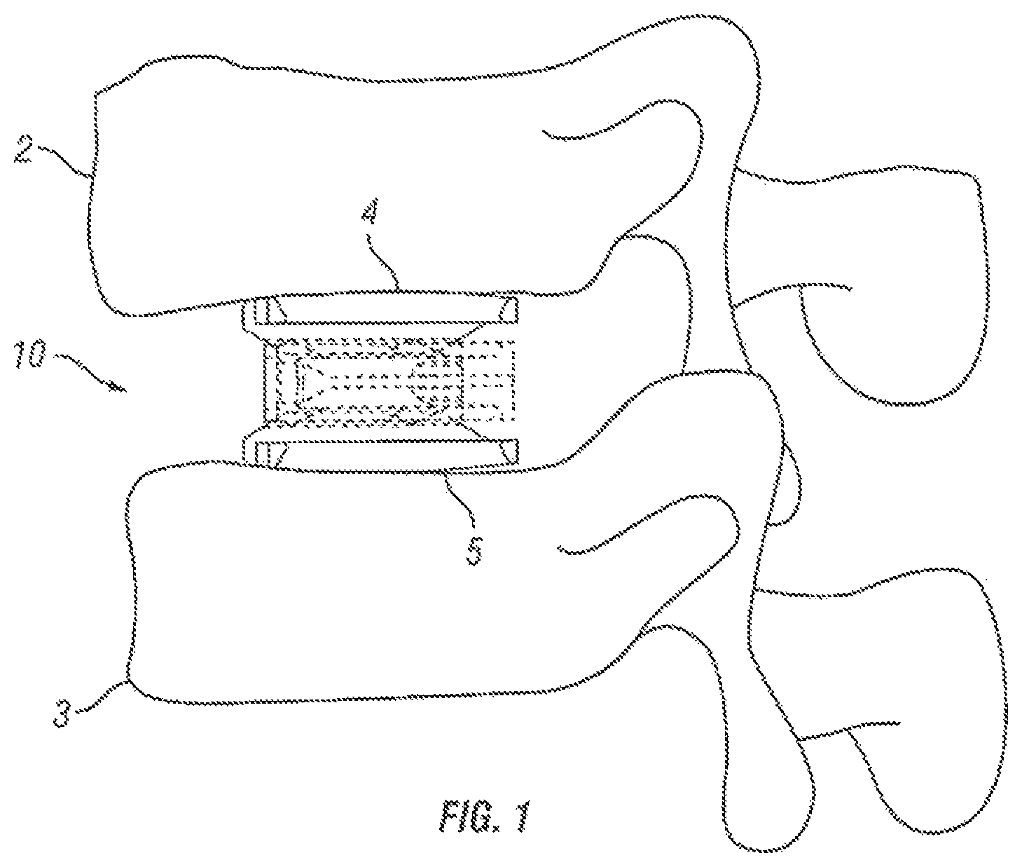 Patent US12376967 — Expandable fusion device and method of installation thereof — Figure 1