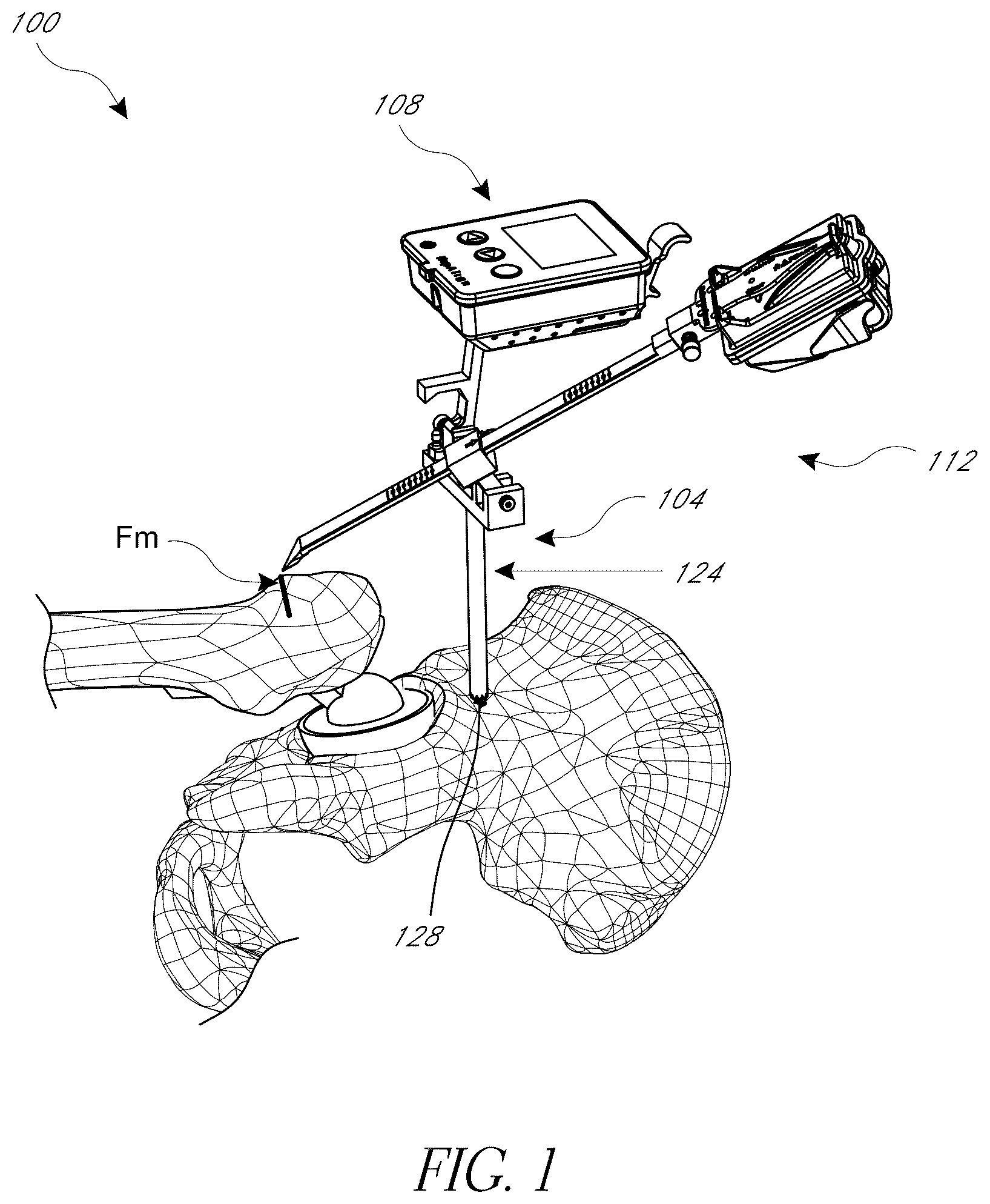 Patent US12376972 — Hip replacement navigation system and method — Figure 1