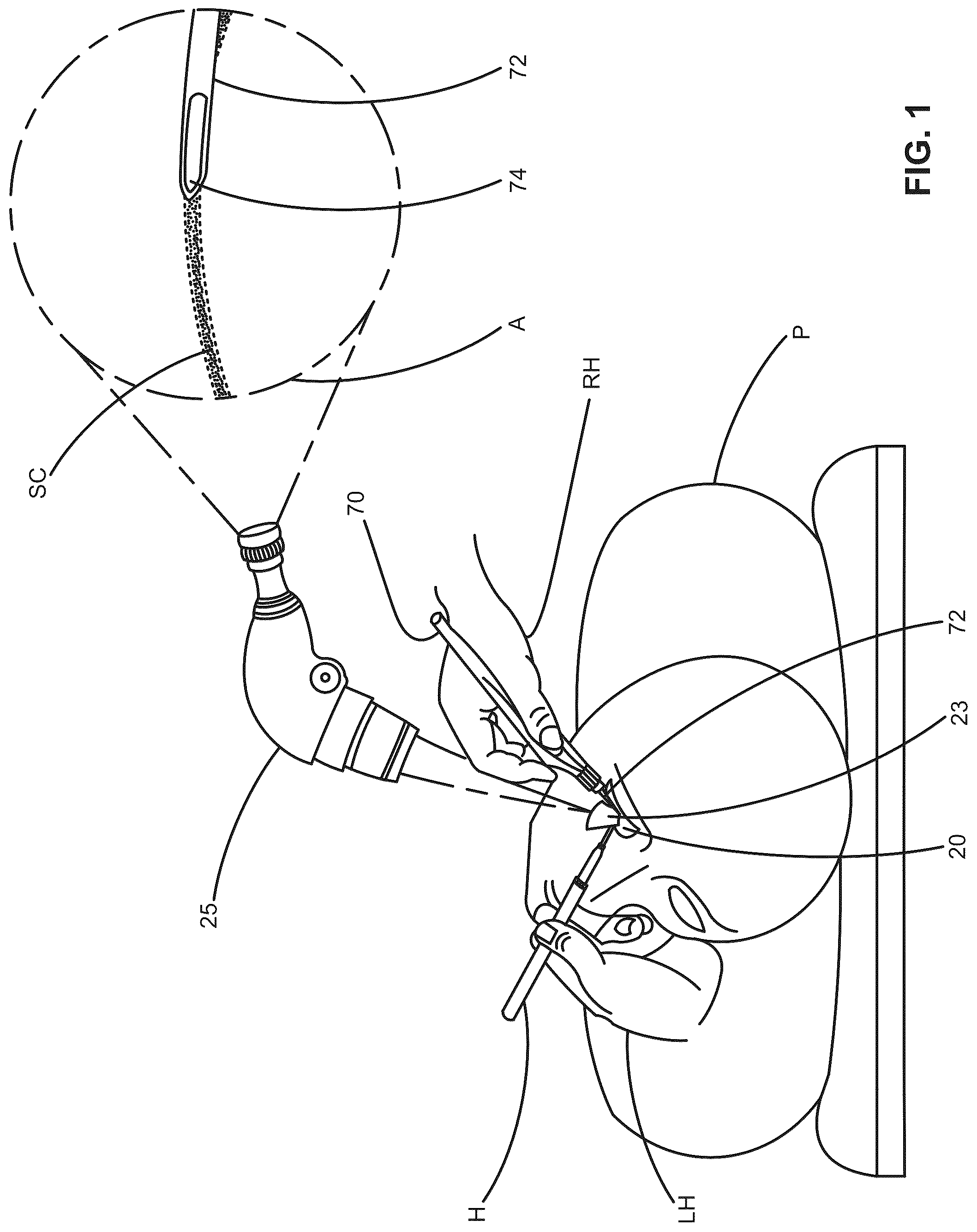 Patent US12376988 — Apparatus for delivering ocular implants into an anterior chamber of the eye — Figure 1