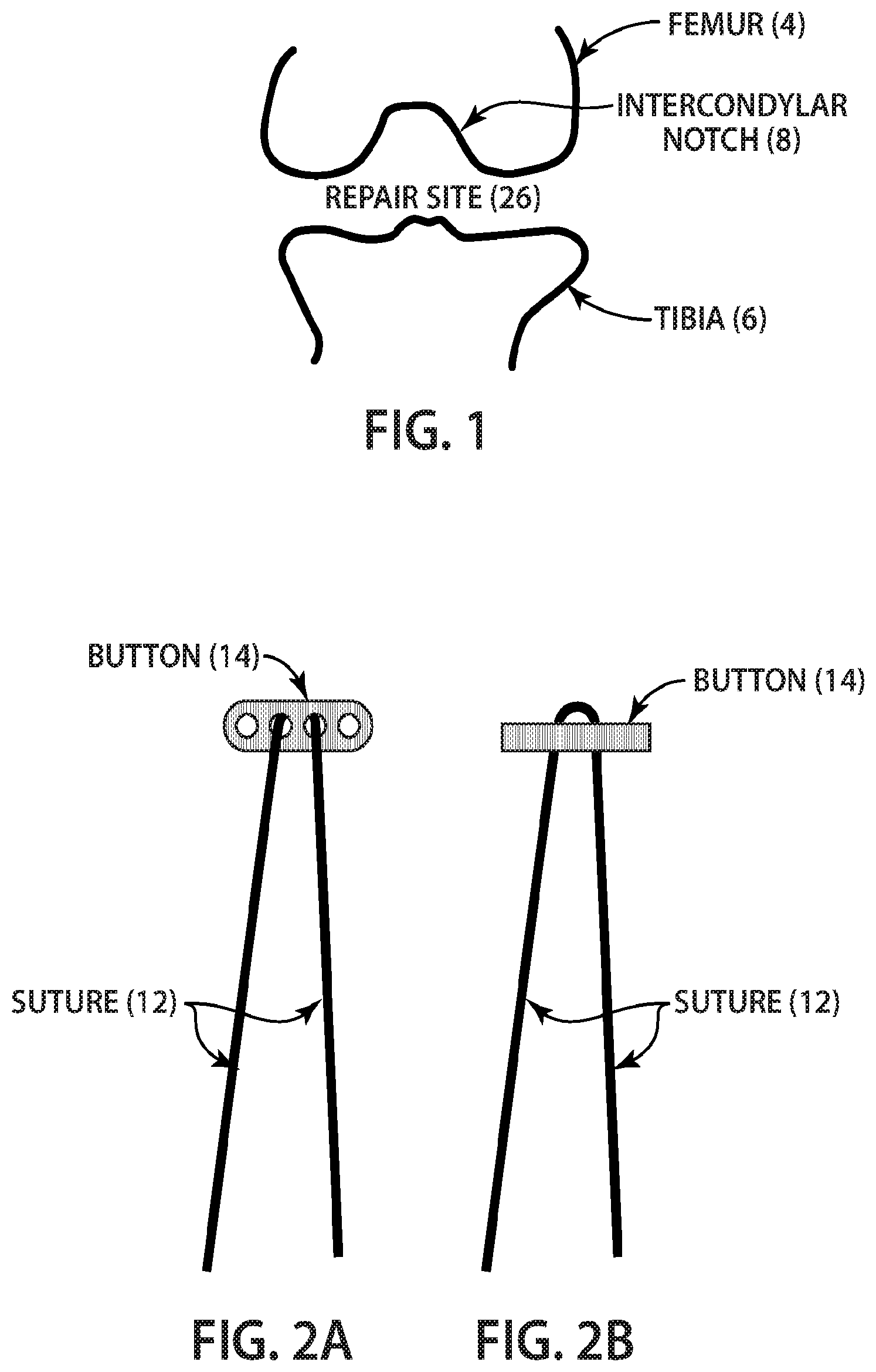 Patent US12377193 — Indirect method of articular tissue repair — Figure 1