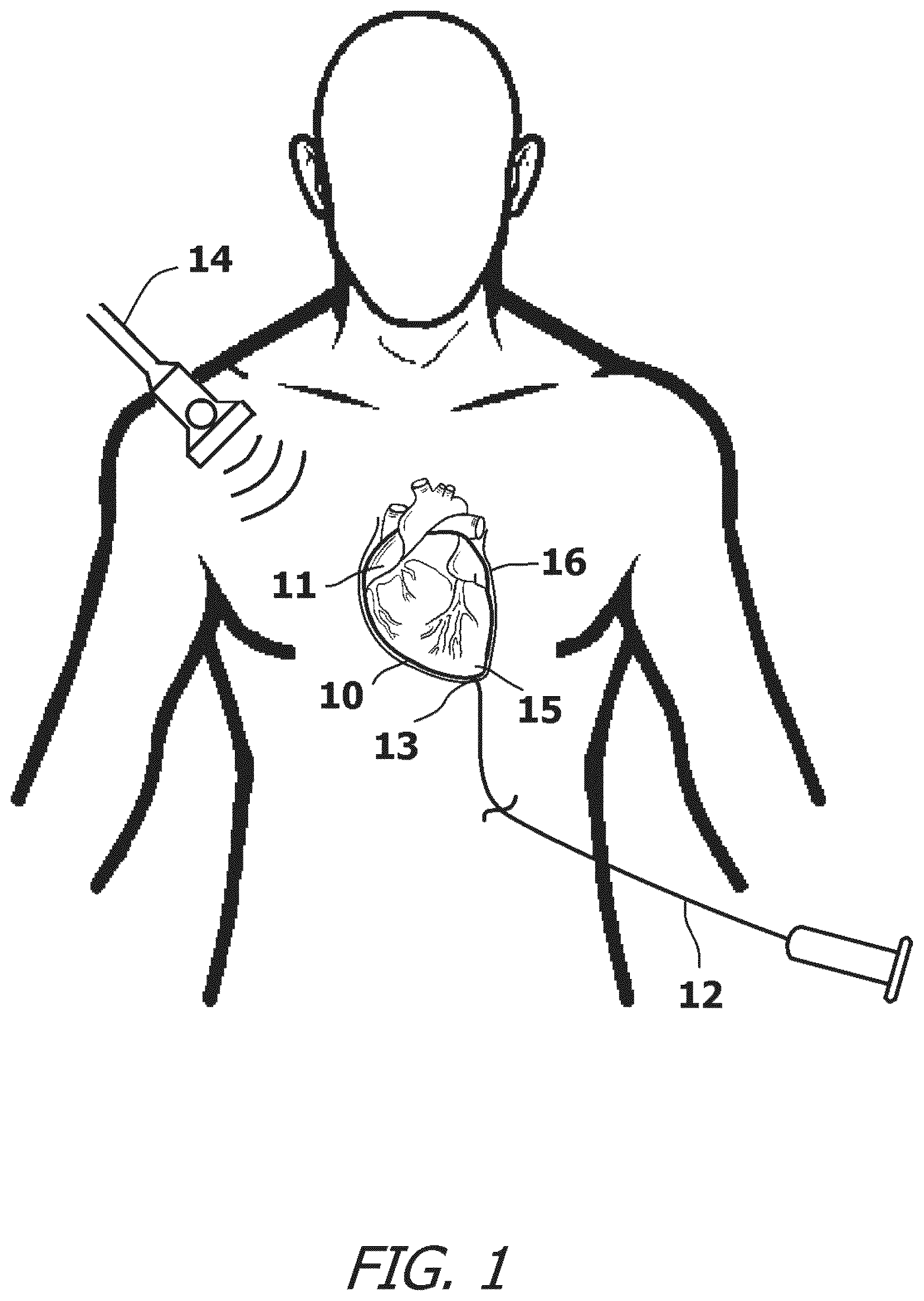 Patent US12377259 — System and method for introducing a construct either on or around the surface of the heart — Figure 1