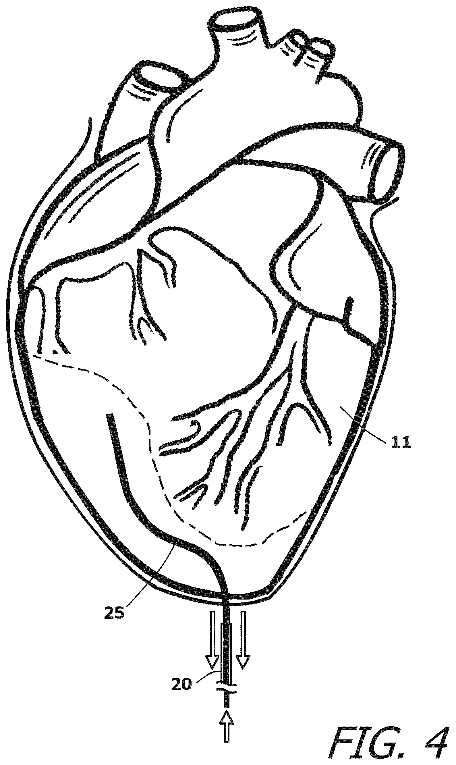 Patent US12377259 Figure 4 – System and method for introducing a construct either on or around the surface of the heart