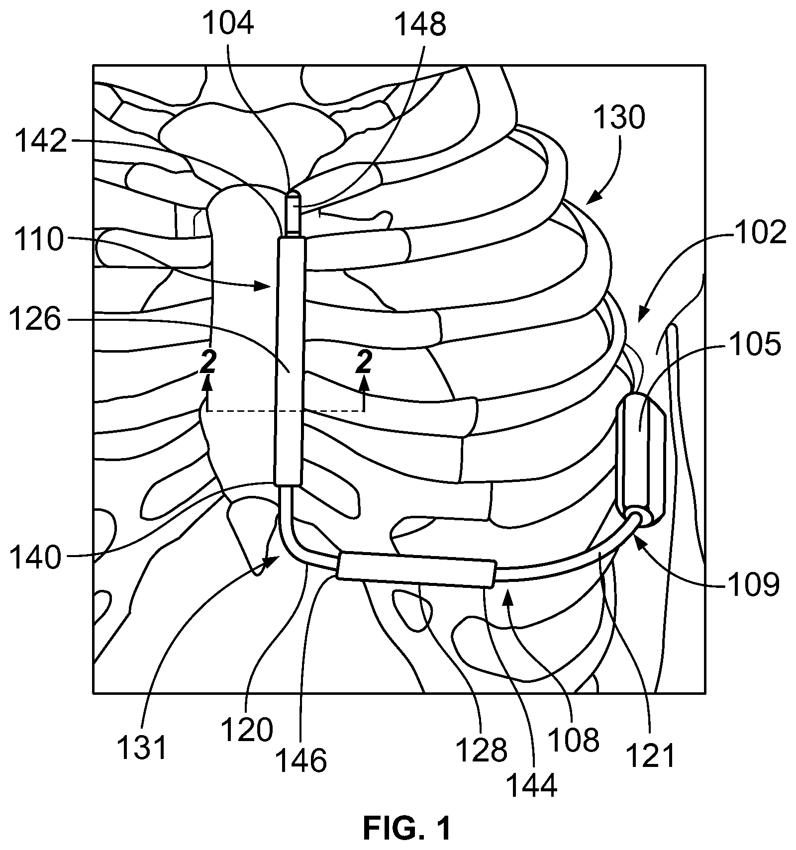 Patent US12377262 — Method and implantable medical device for reducing defibrillation impedance — Figure 1