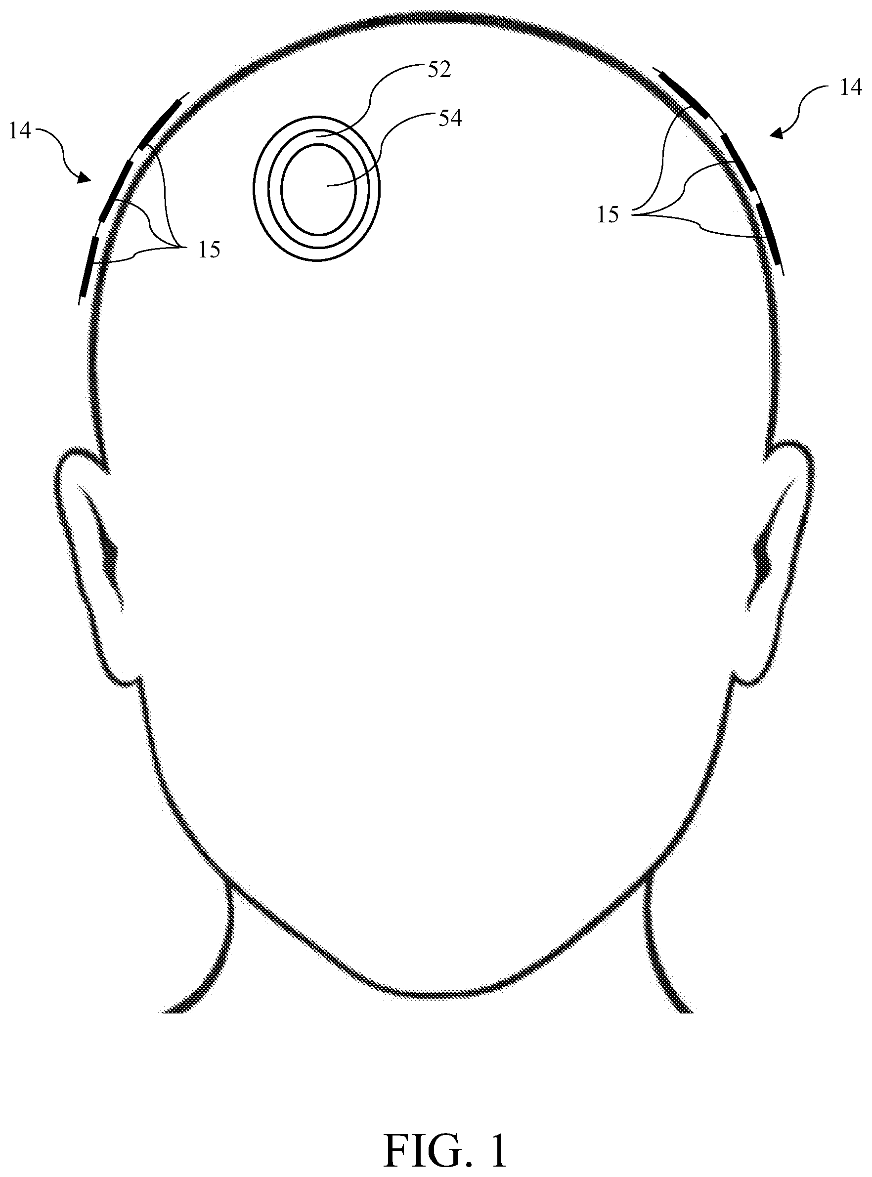 Patent US12377265 Figure 1 – Nonconductive field guide for resection cavity, and systems and methods of using same