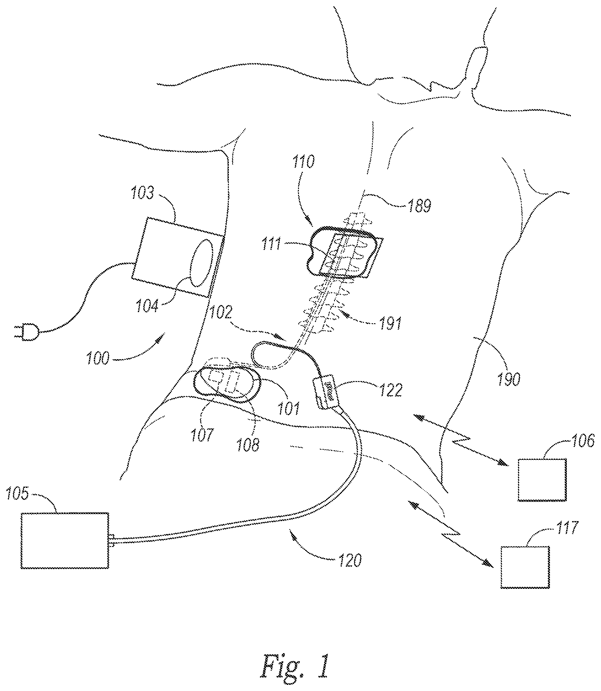 Patent US12377271 — Medical device communication and charging assemblies for use with implantable signal generators, and associated systems and methods — Figure 1