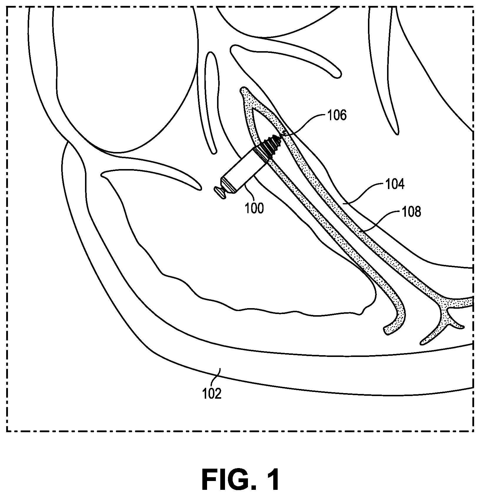 Patent US12377277 — Biostimulator having burrowing nose — Figure 1