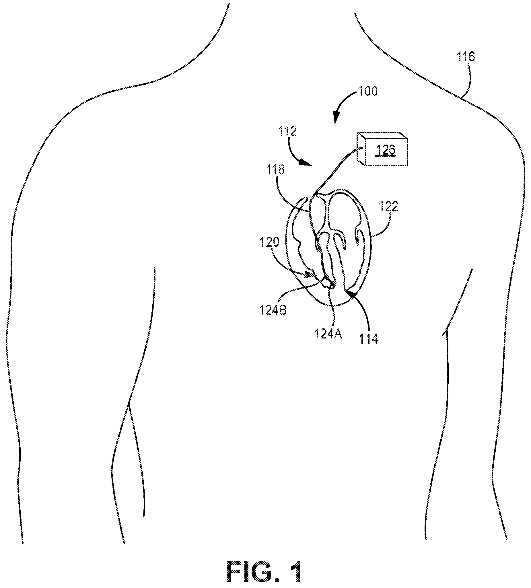 Patent US12377278 — Polymeric enclosure for implantable medical device — Figure 1