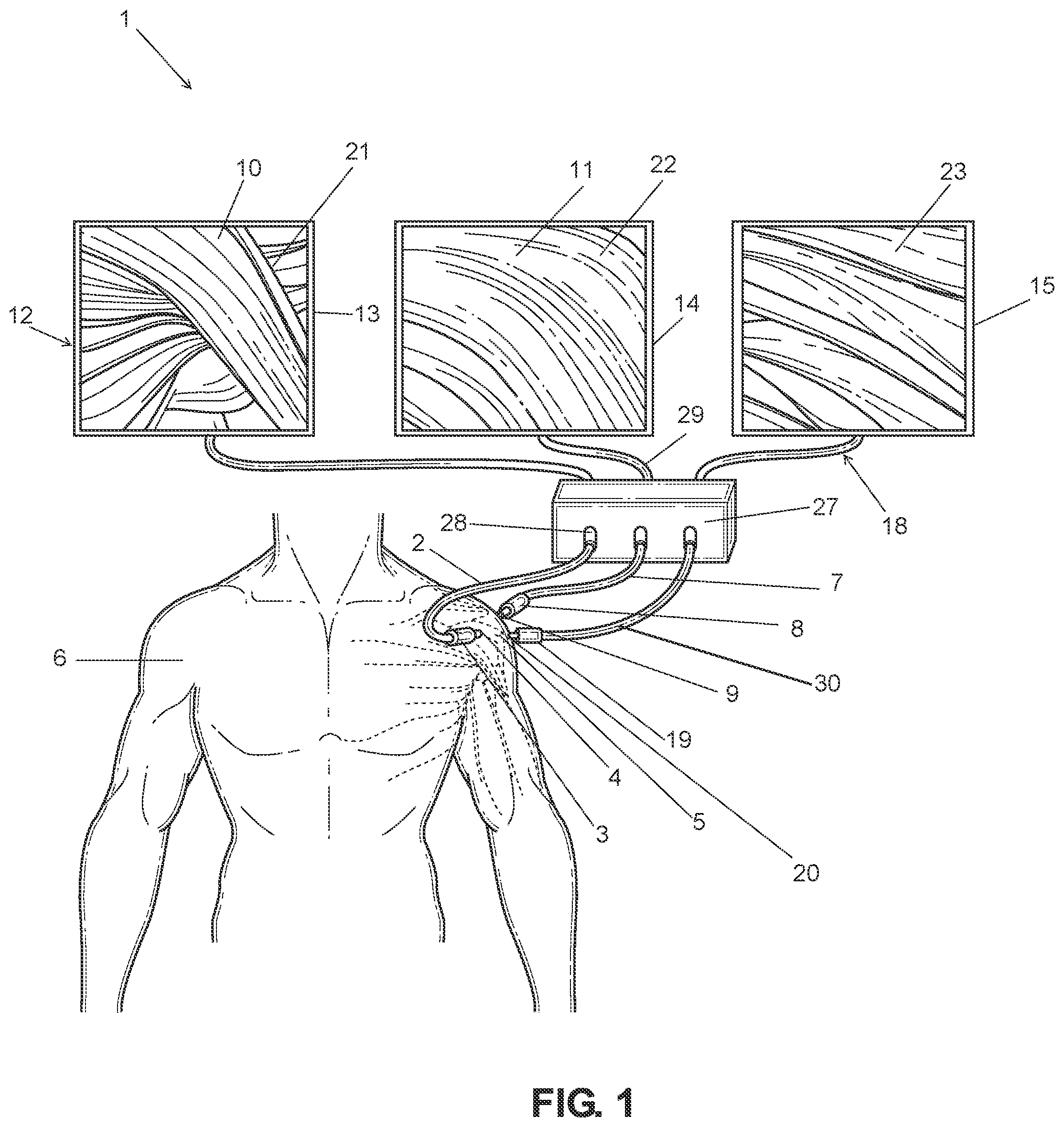 Patent US12396632 — Enhanced visualization methods and systems for endoscopic procedures — Figure 1