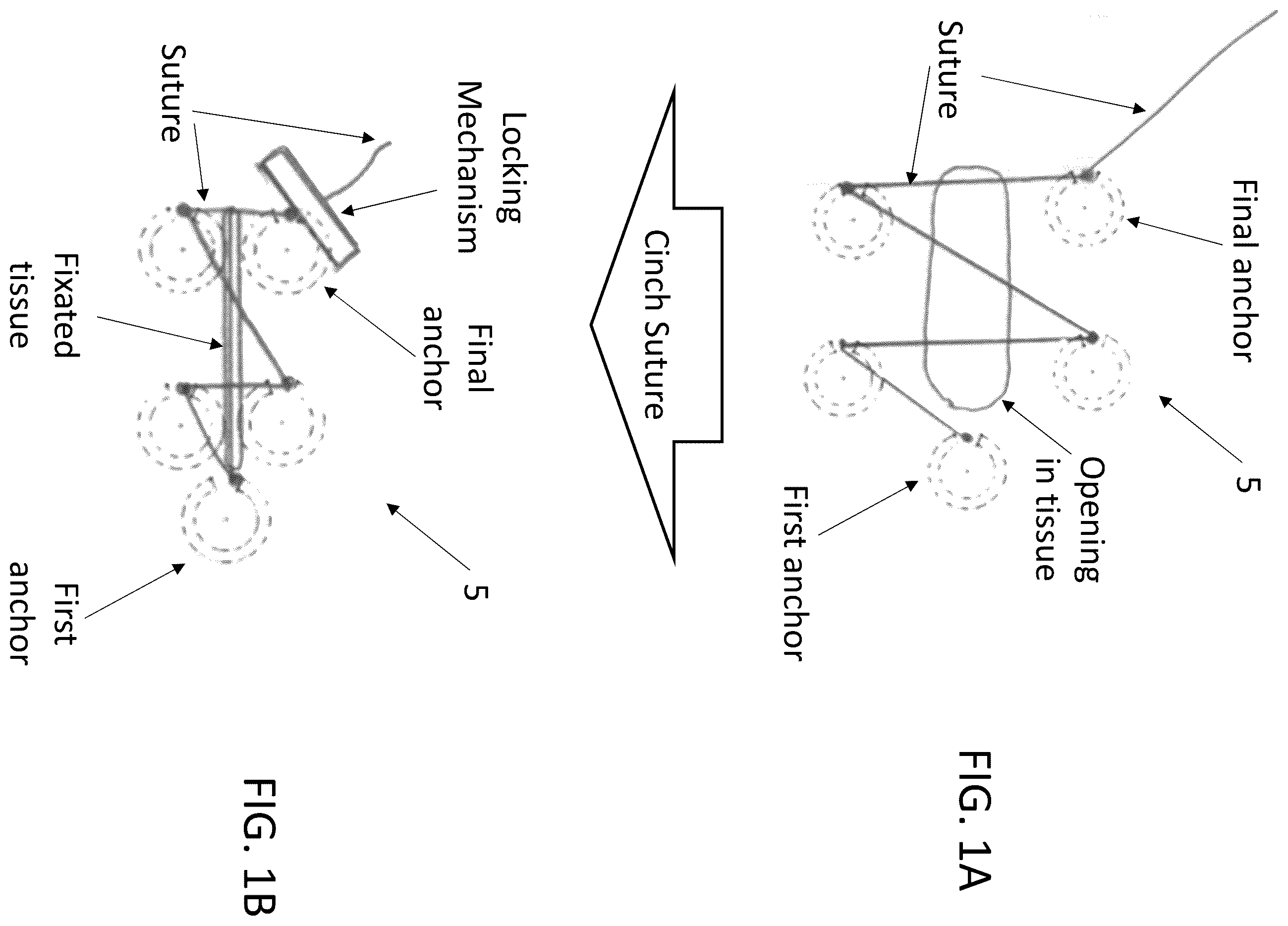 Patent US12396719 — Soft tissue fixation system — Figure 1