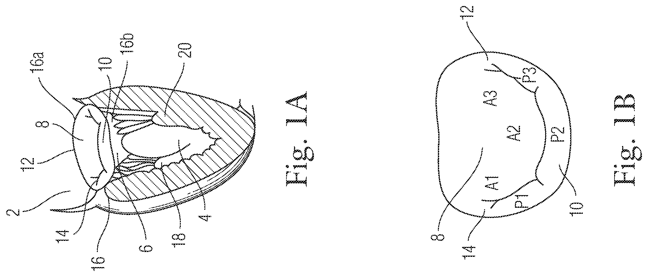 Patent US12396720 — Devices and methods for locating and implanting tissue anchors at mitral valve commissure — Figure 1
