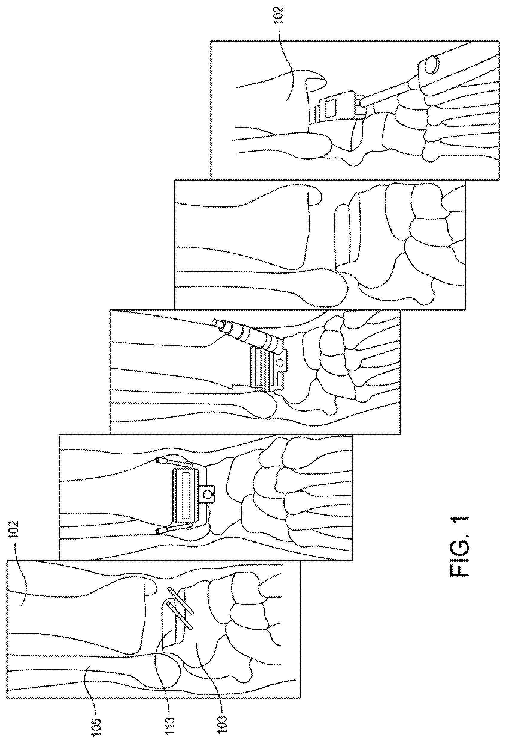 Patent US12396755 — Methods and apparatus for joint repair — Figure 1
