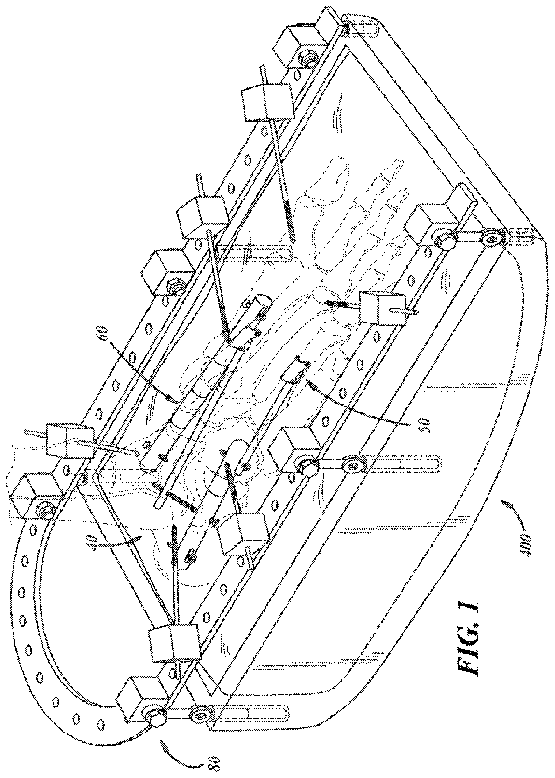 Patent US12396757 Figure 1 – Implants and methods for treating Charcot foot and other conditions