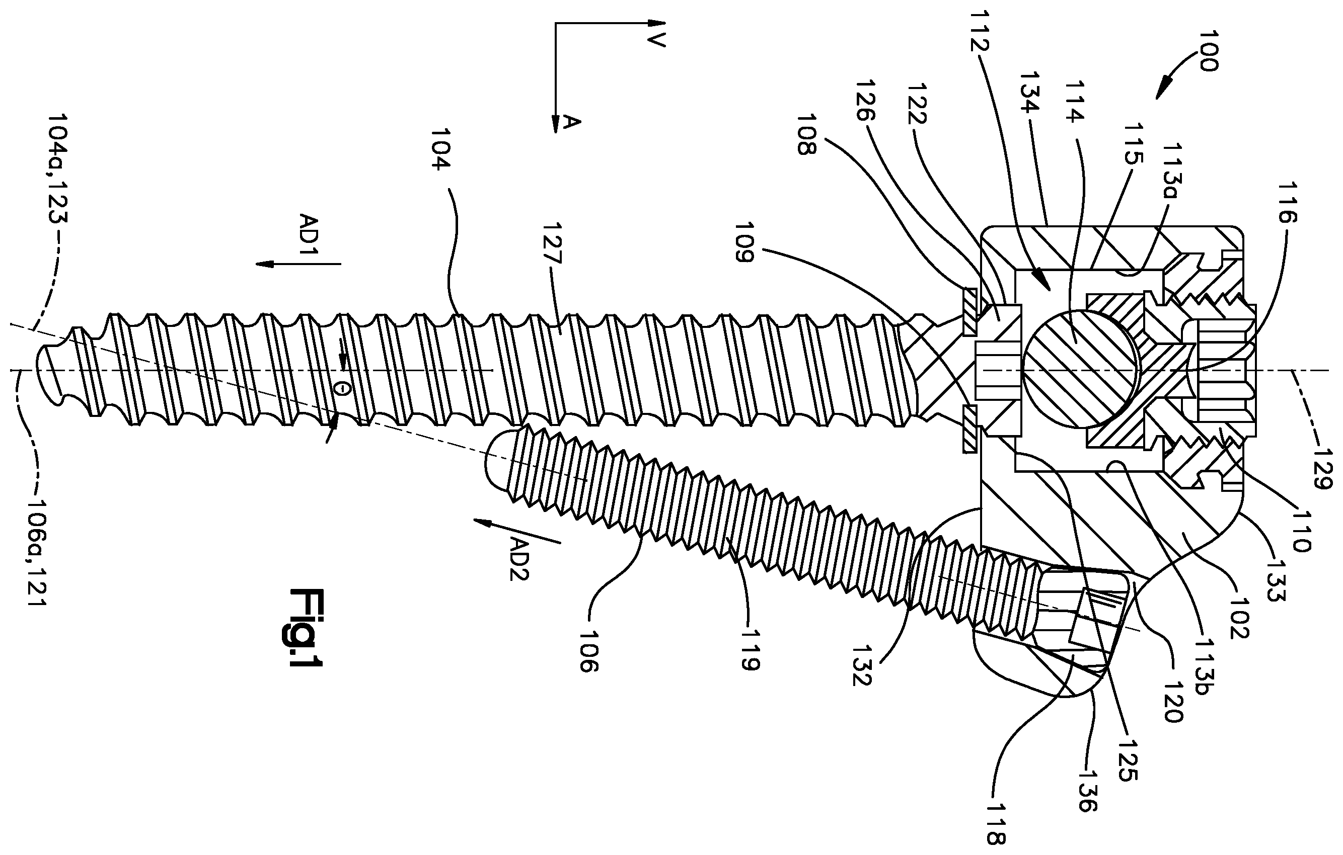 Patent US12396761 Figure 1 – Device, kit and method for correction of spinal deformity