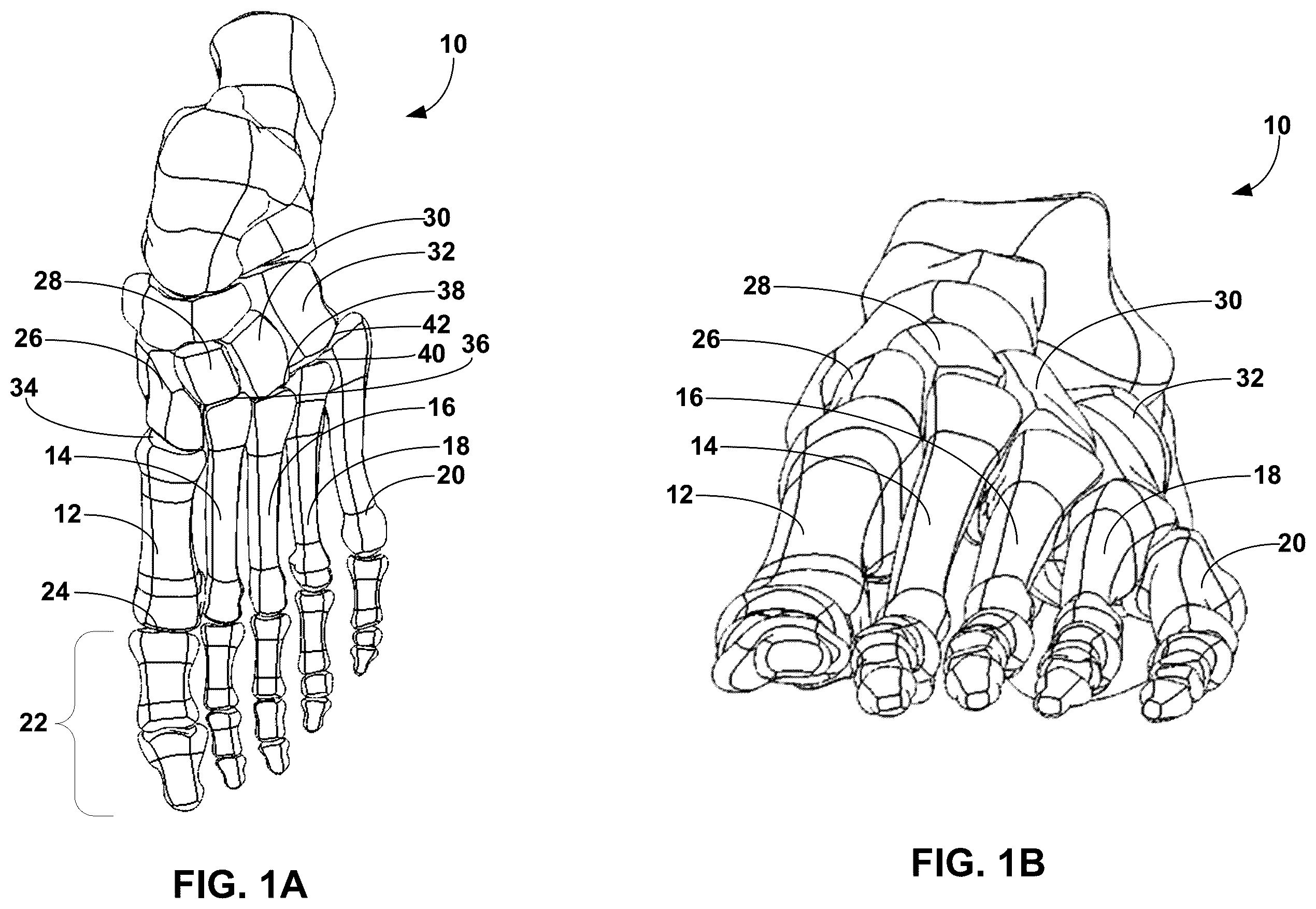 Patent US12396770 — Devices and techniques for treating metatarsus adductus — Figure 1