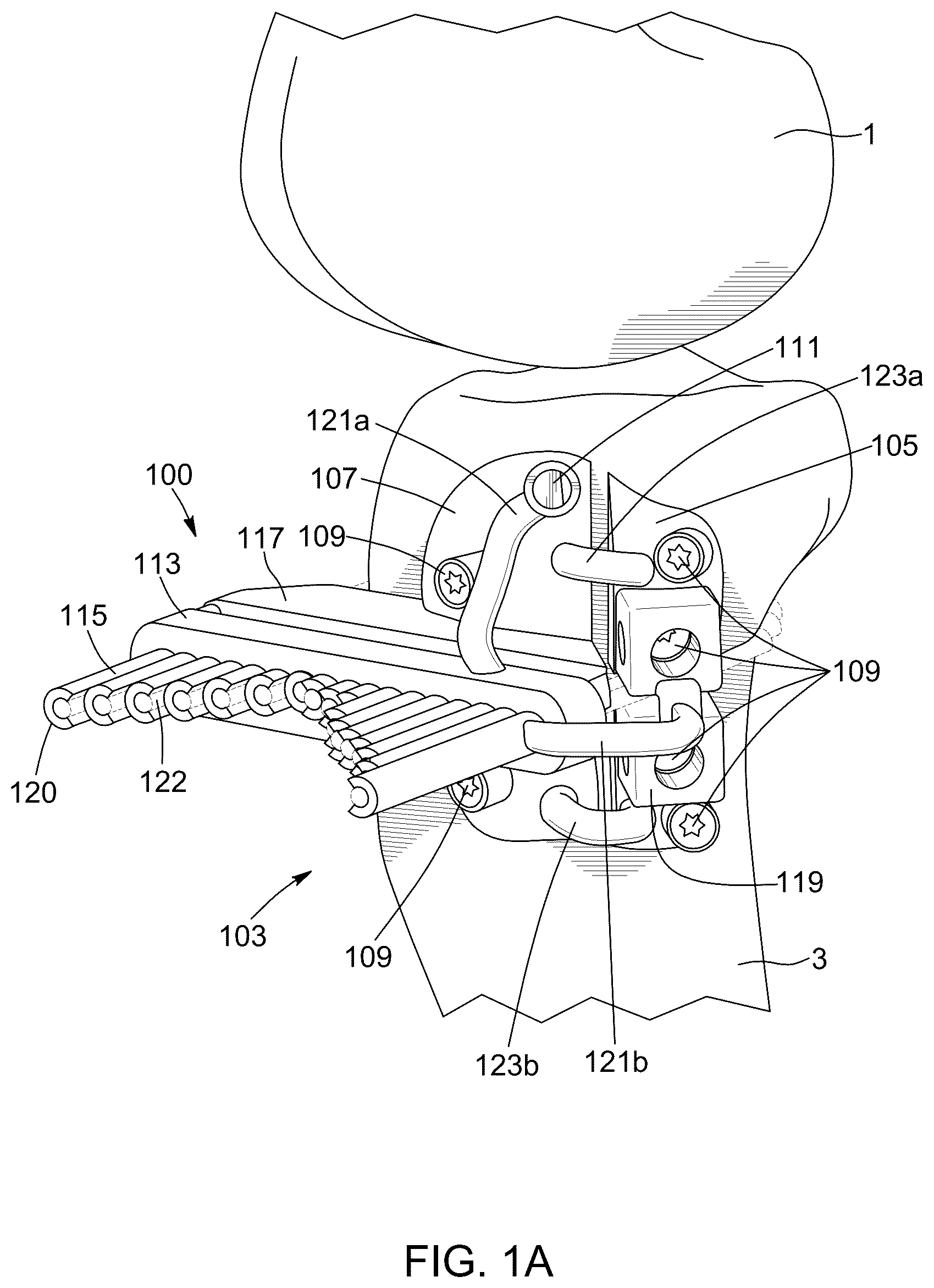 Patent US12396796 — Surgical kit for knee osteotomies and corresponding preoperative planning method — Figure 1