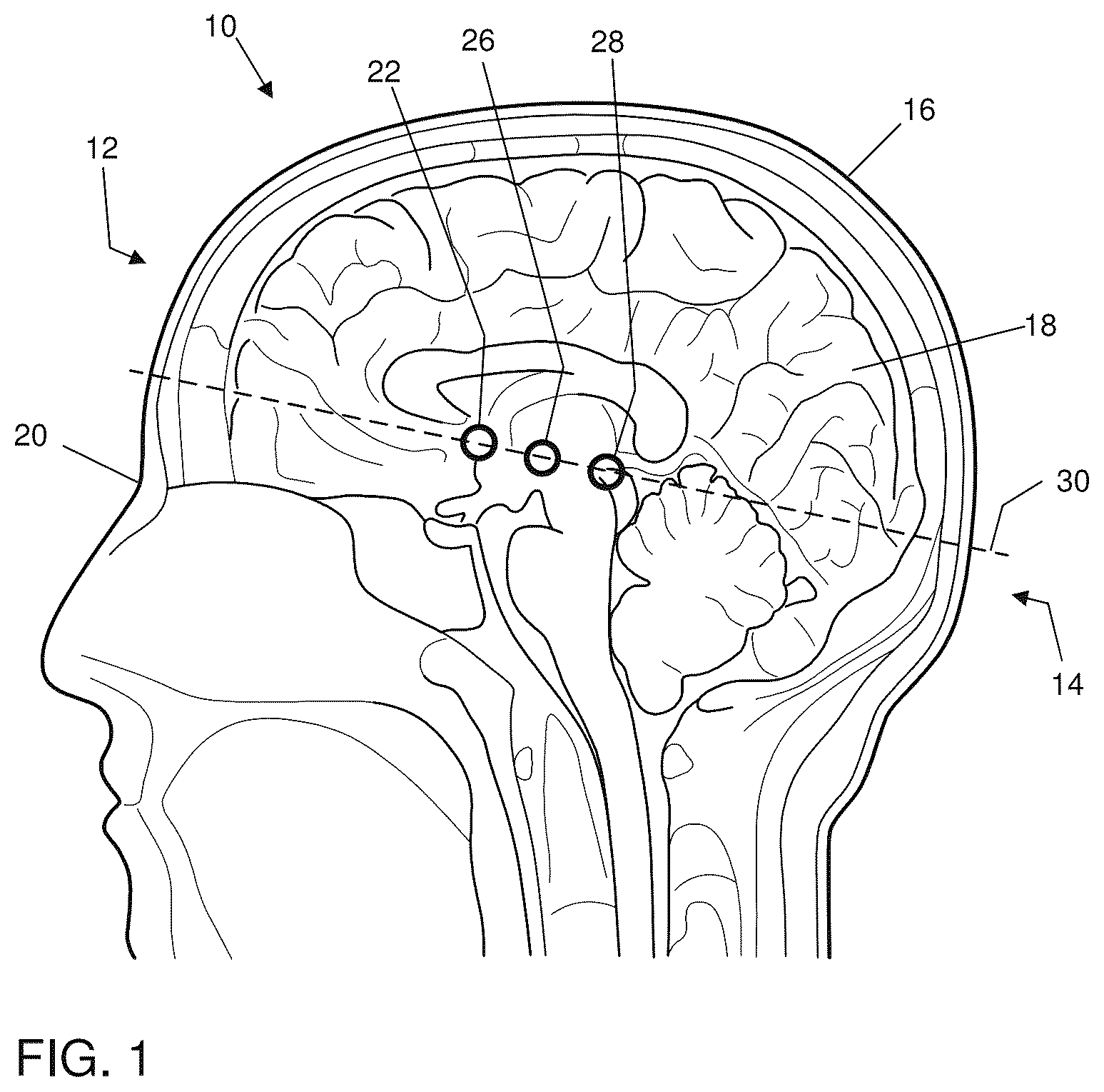 Patent US12396821 — Devices for assisting neurosurgical interventions — Figure 1