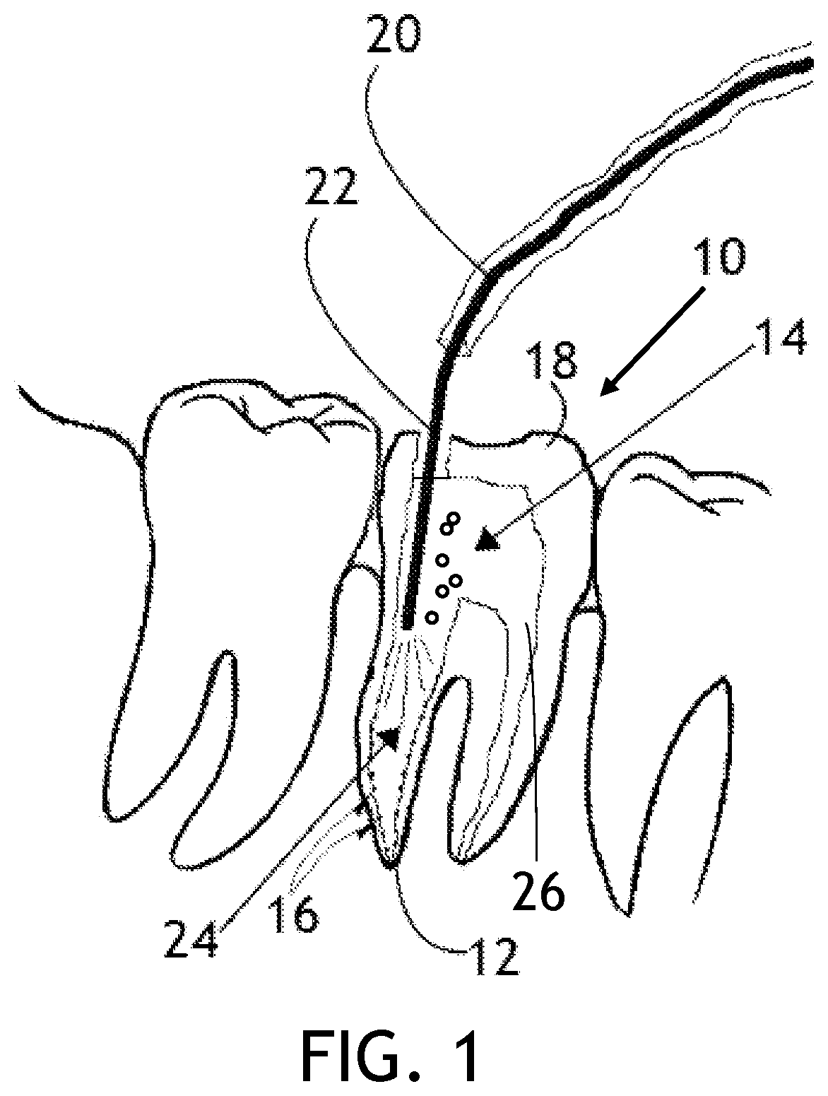 Patent US12396823 — Laser endodontic procedures utilizing alcohol based indocyanine green solutions — Figure 1