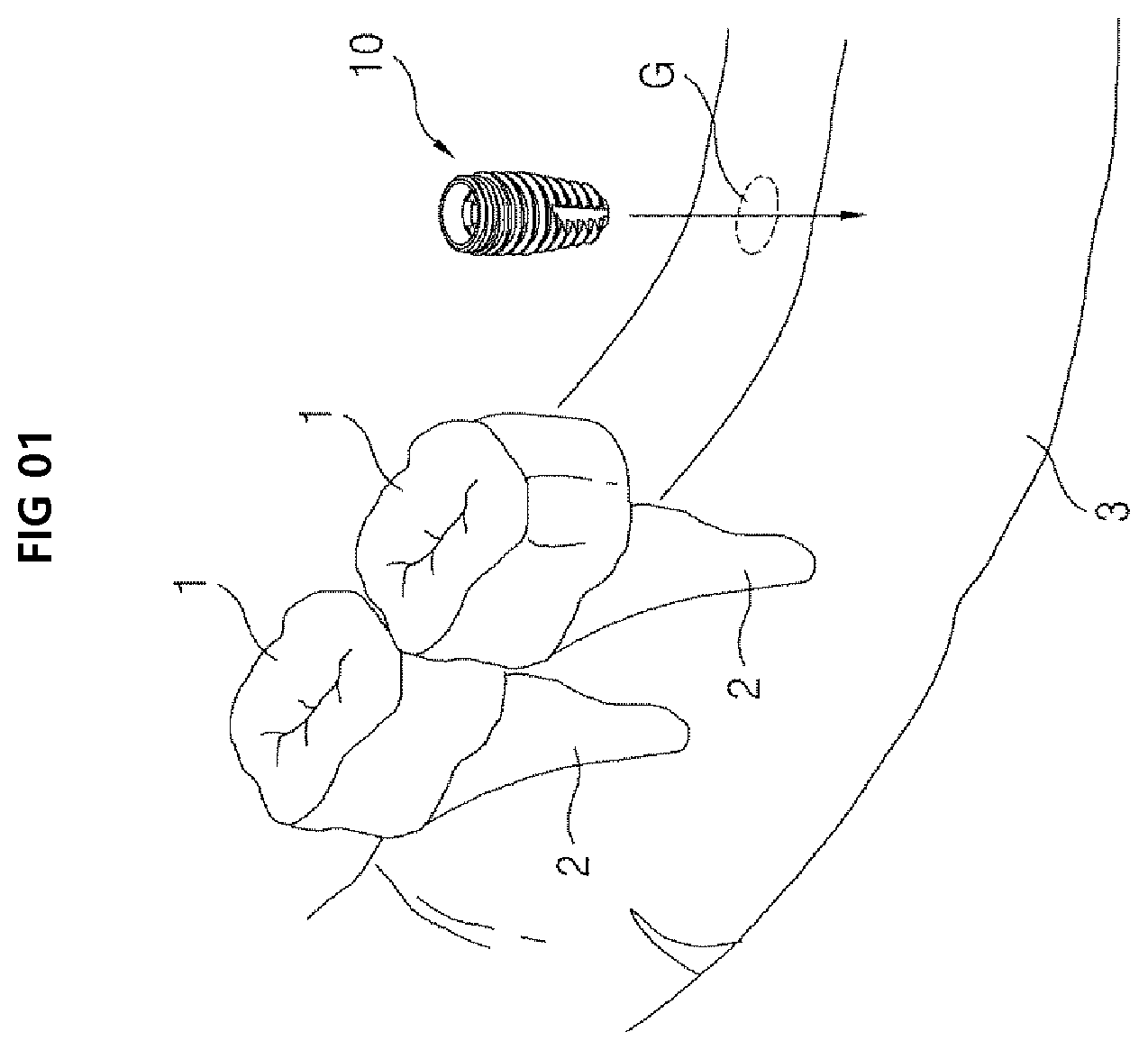 Patent US12396825 — Fixture of dental implant — Figure 1